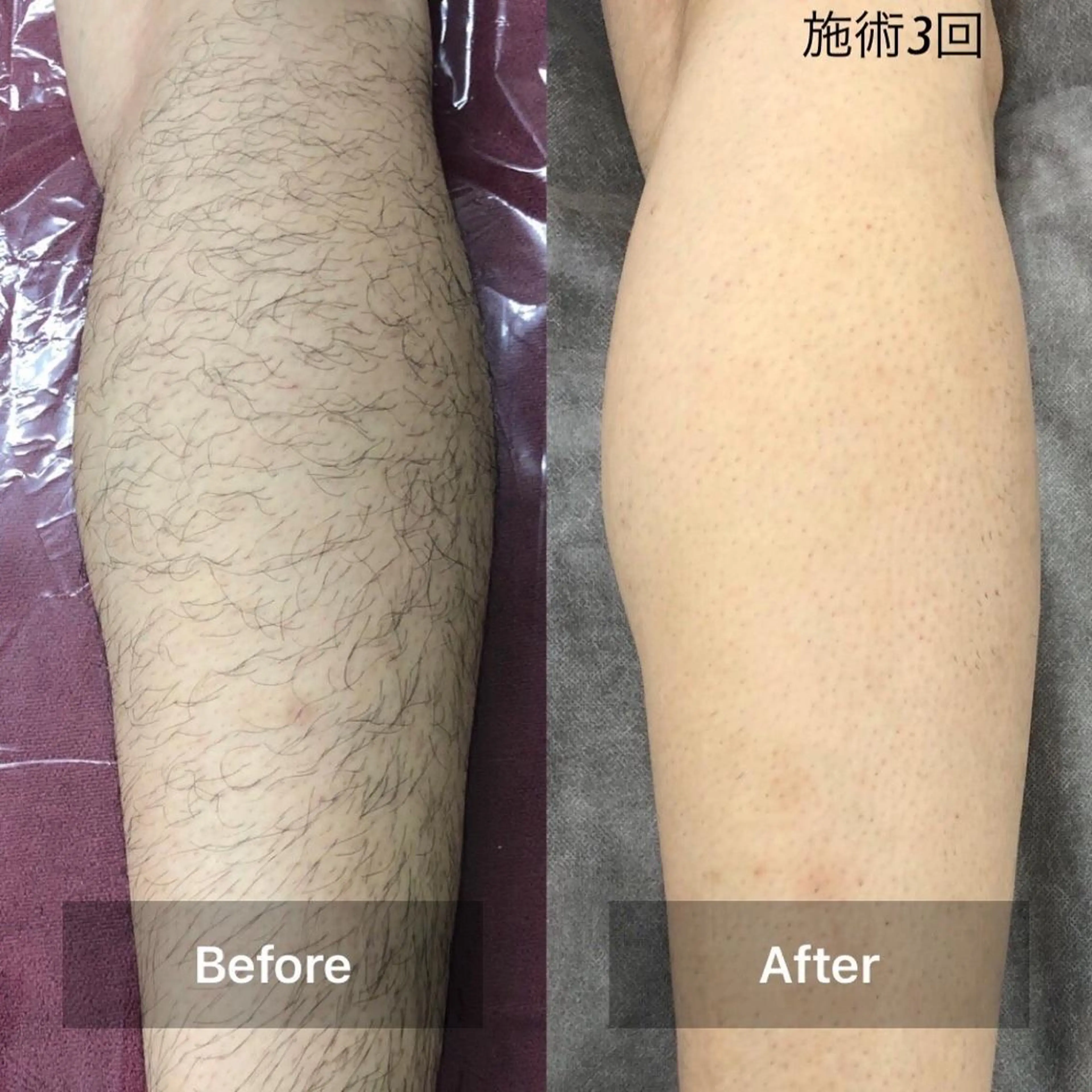 【メンズ】足セット脱毛(ひざ・足の甲・ひざ上・ひざ下) ♪保湿ケア付♪の写真