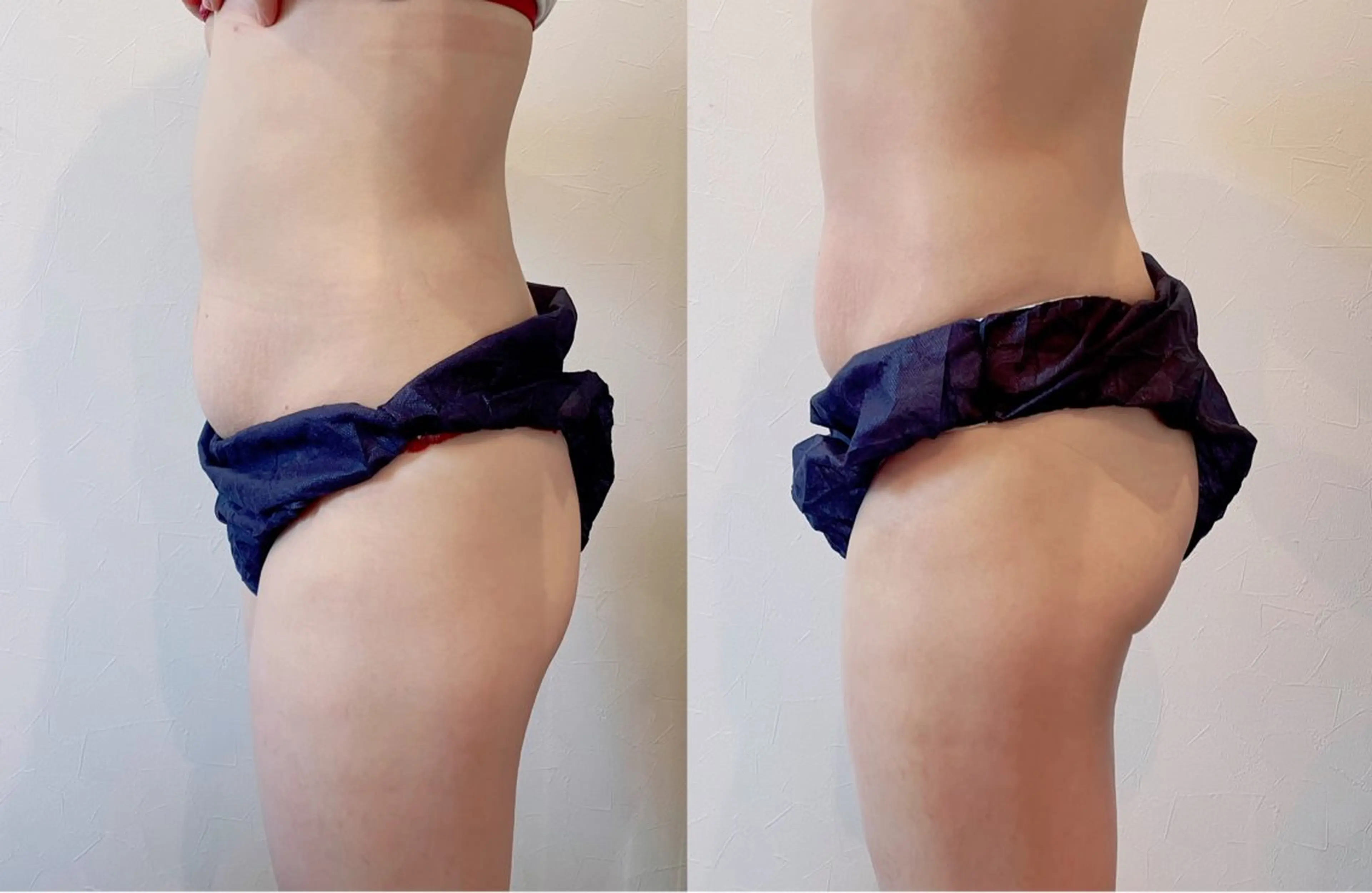 ミニモ限定❣️選べる部位【固くなったお肉ケア】キャビ脂肪を流し+微弱電流引き締めの写真