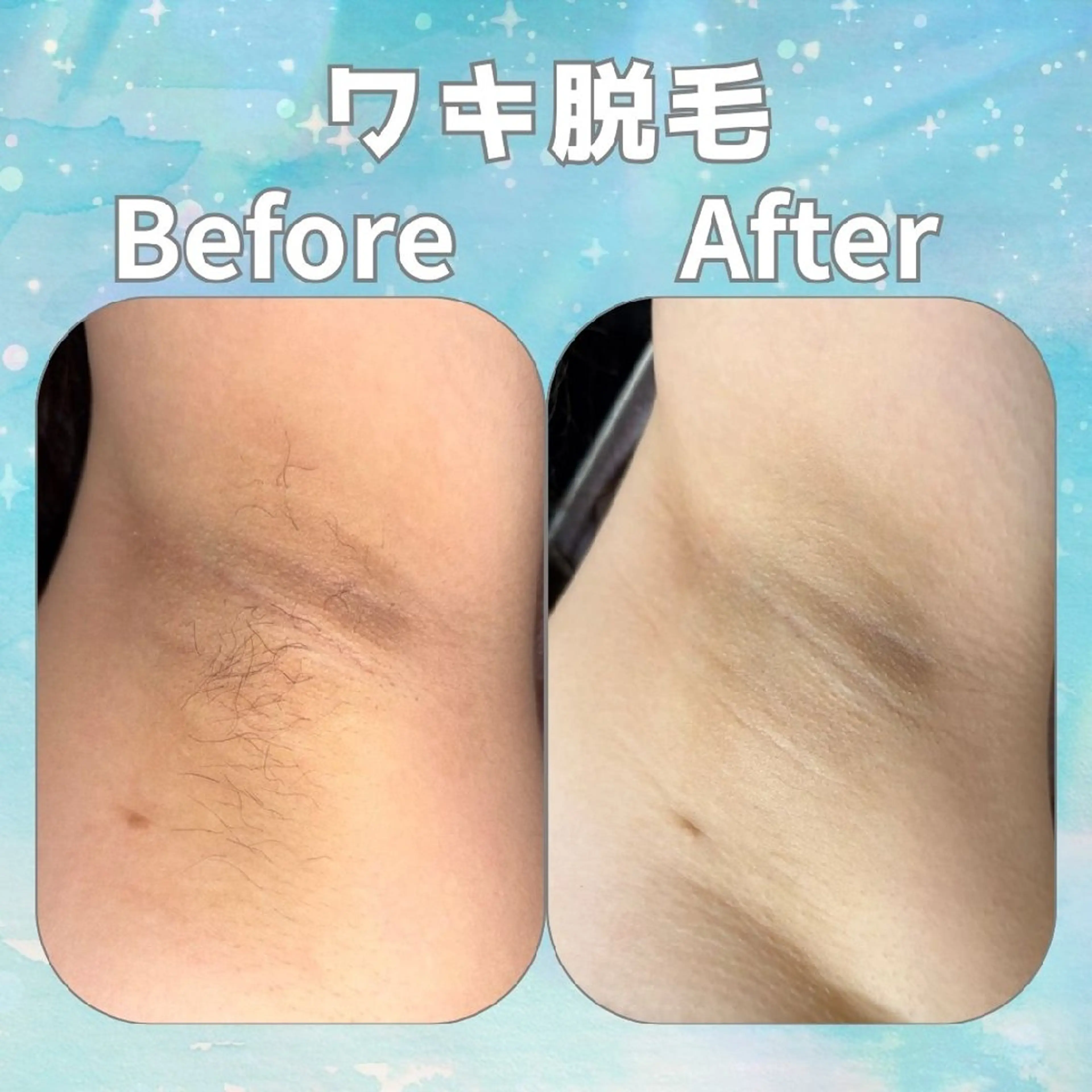 女性限定！！！　全身脱毛の写真