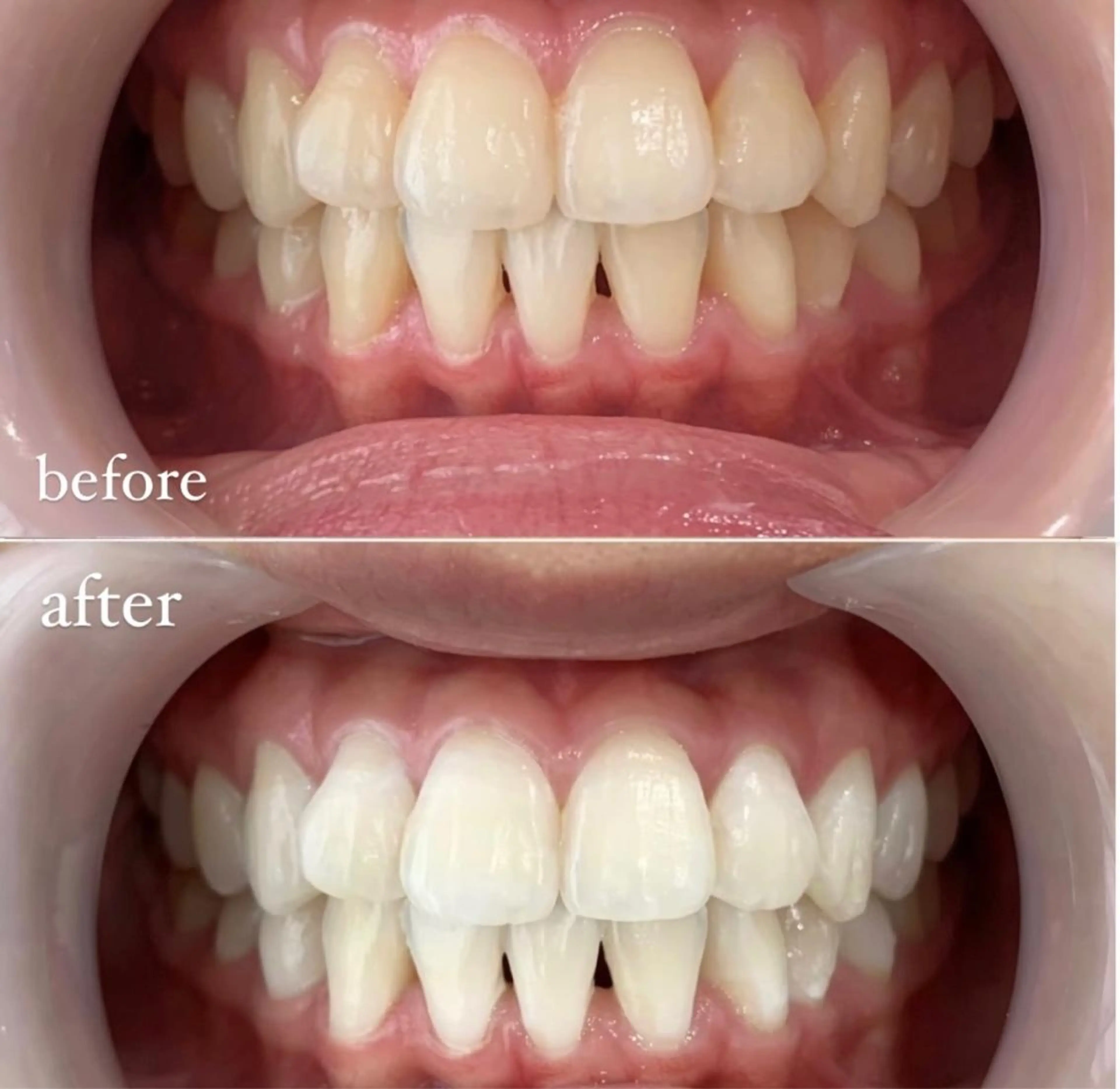 セルフホワイトニング【20分照射】の写真