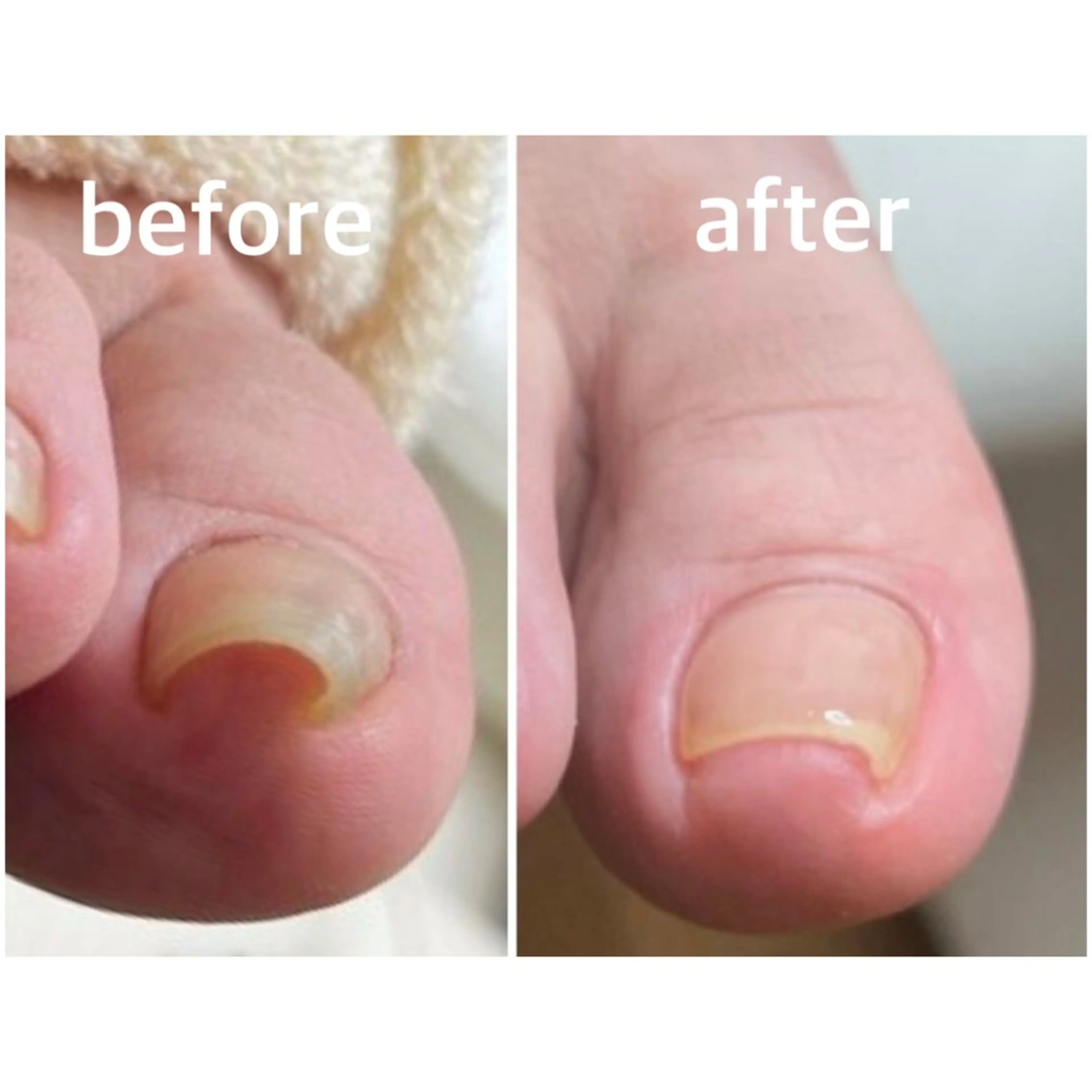 爪トラブル改善★【巻き爪補正】¥13,000→¥11,000の写真
