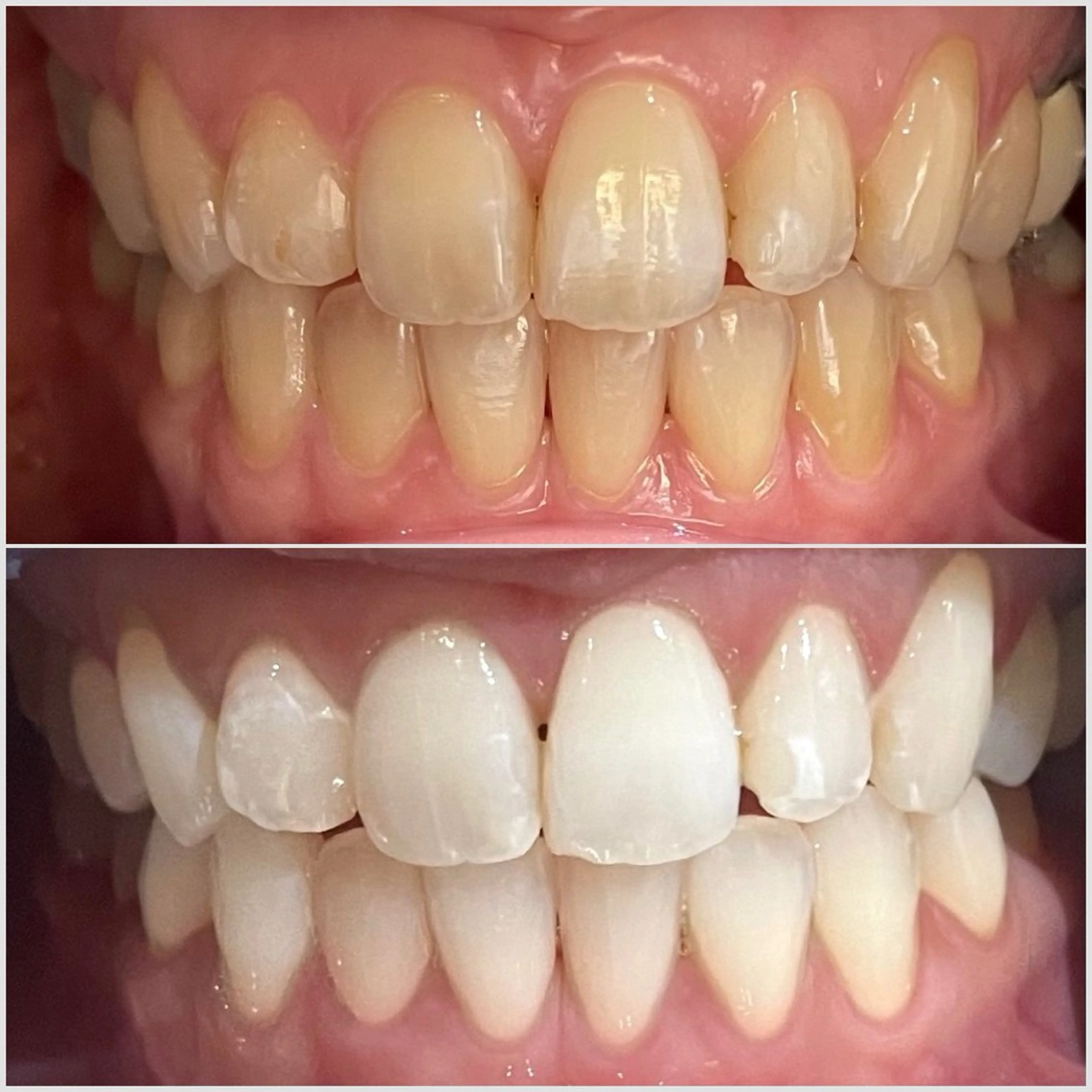 【毎月3名限定】Before Afterの写真投稿と口コミで3980円！平日限定ホワイトニングのみのモニターコース🍓の写真