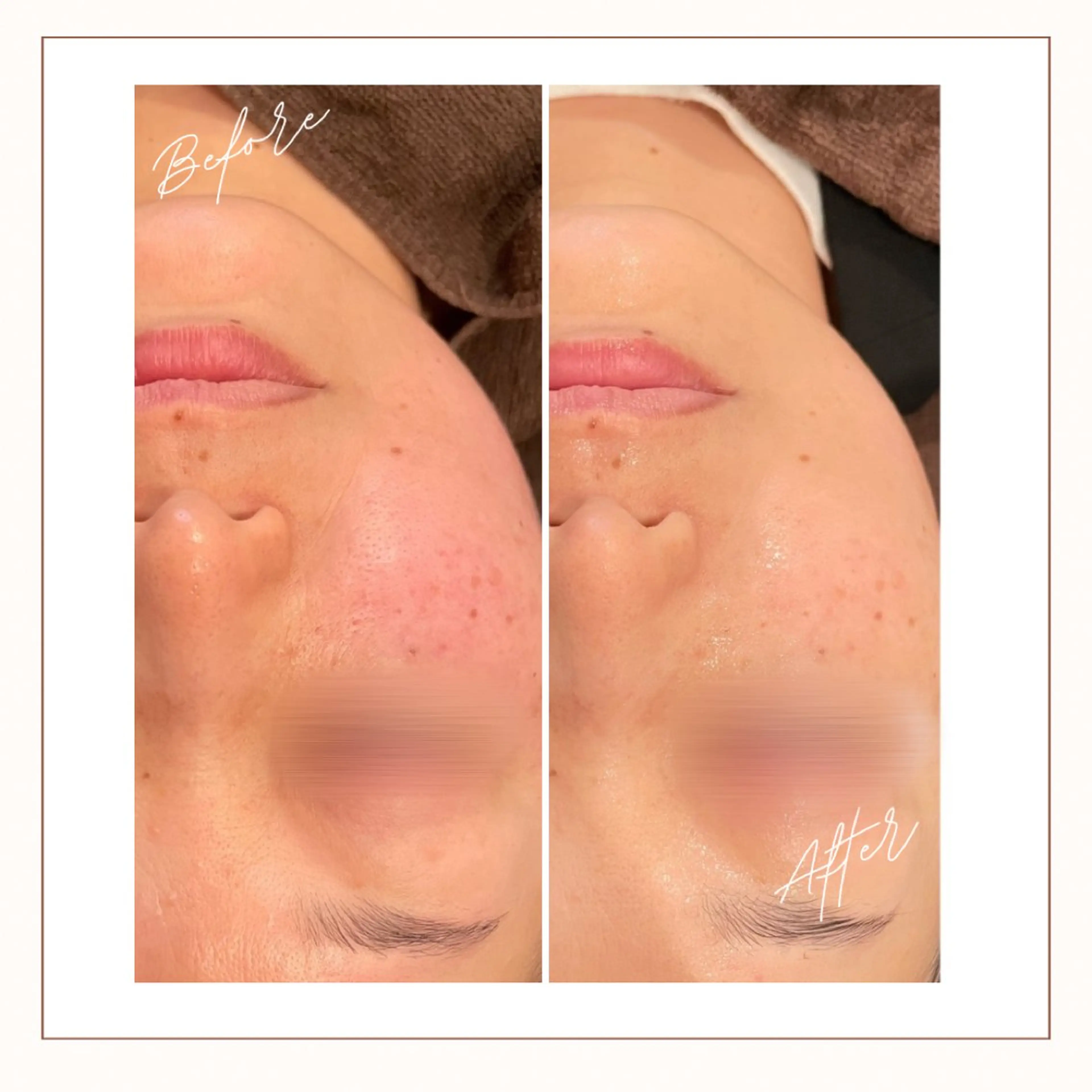 エステ 倉敷/玉島/20代 からの大人毛穴洗浄のエステ・リラクイメージ