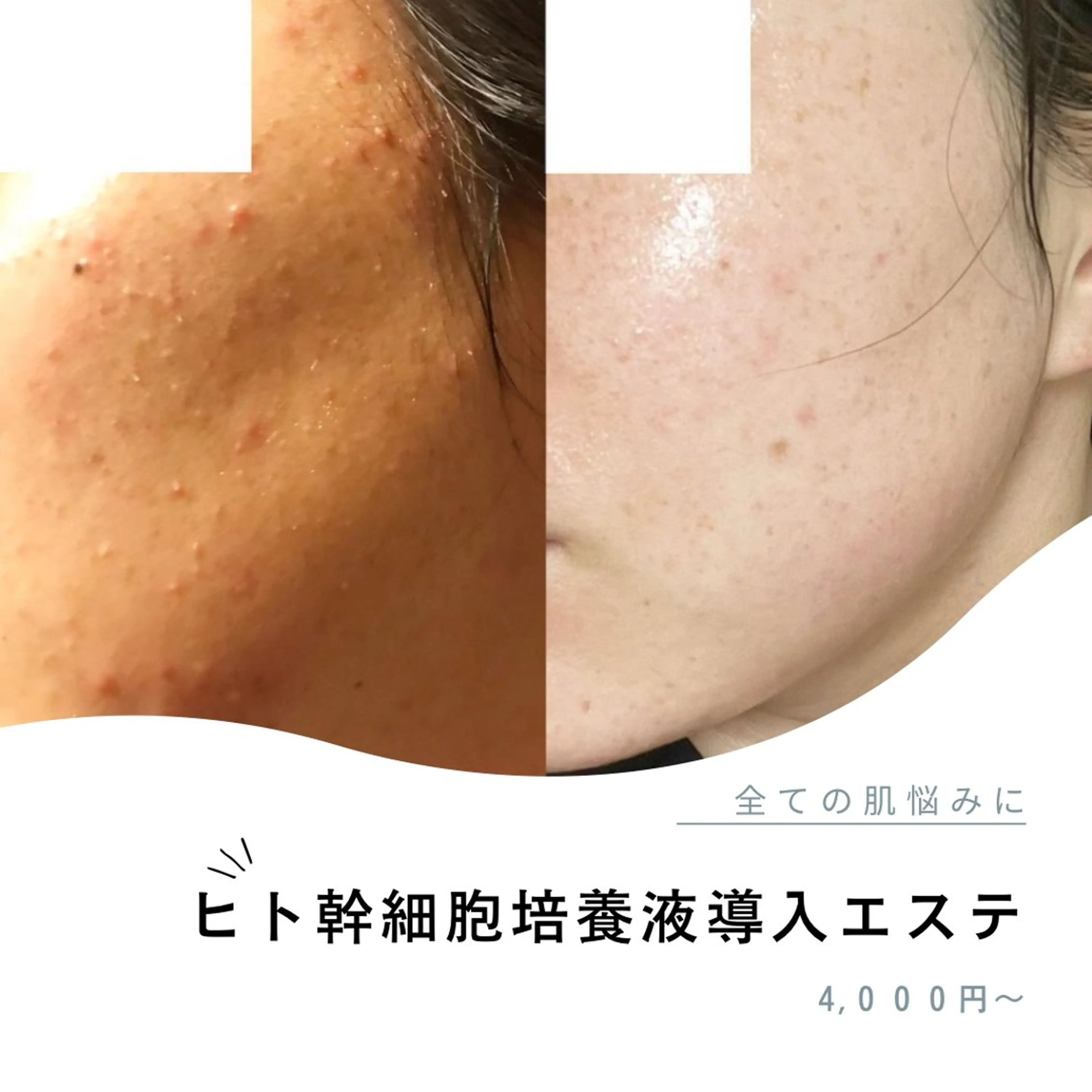 ニキビ肌、毛穴でお悩みの方🌱目指せつやつや美肌✨ヒト幹細胞エステの写真