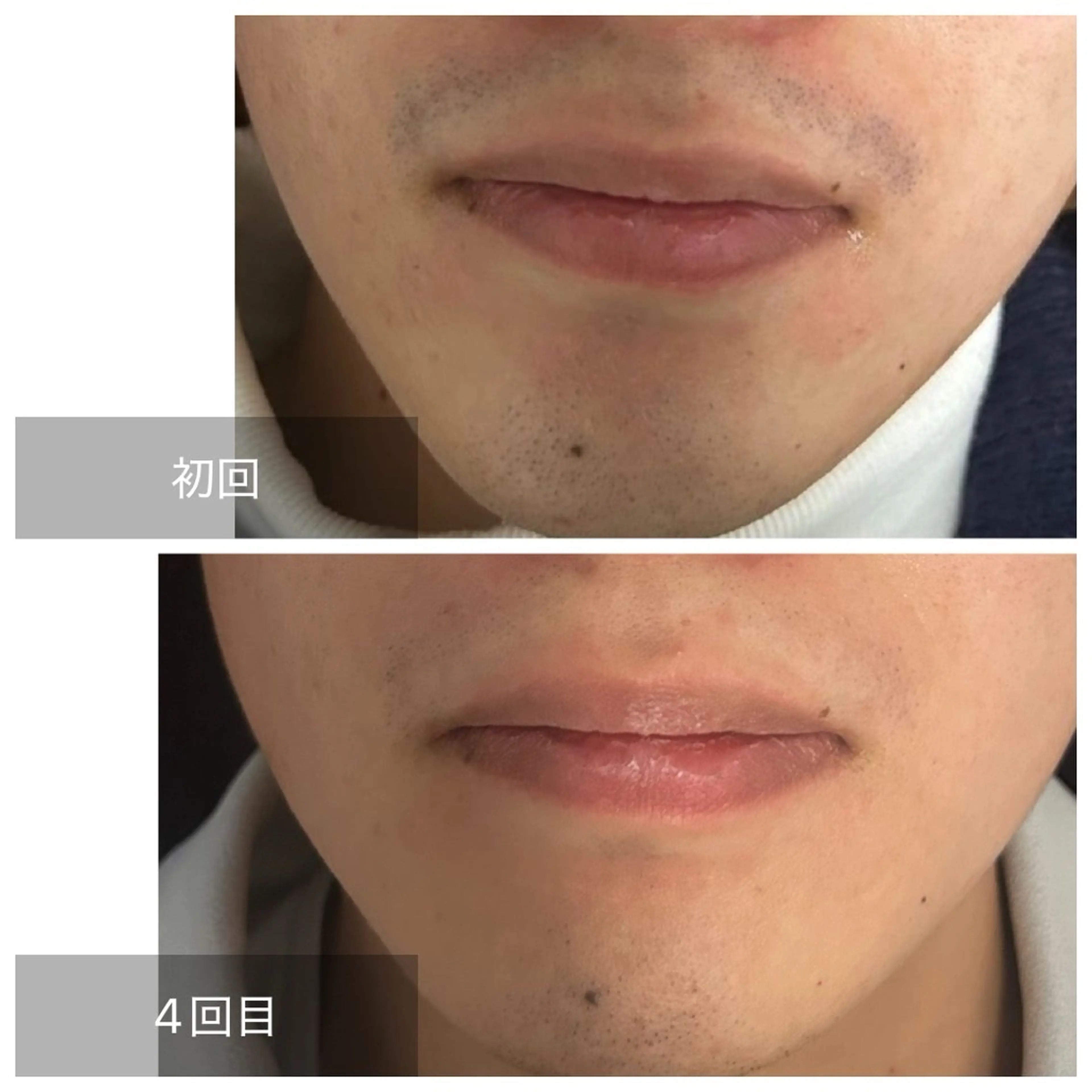 【人気NO.1!毎朝が楽に】メンズヒゲ脱毛 ¥3500の写真