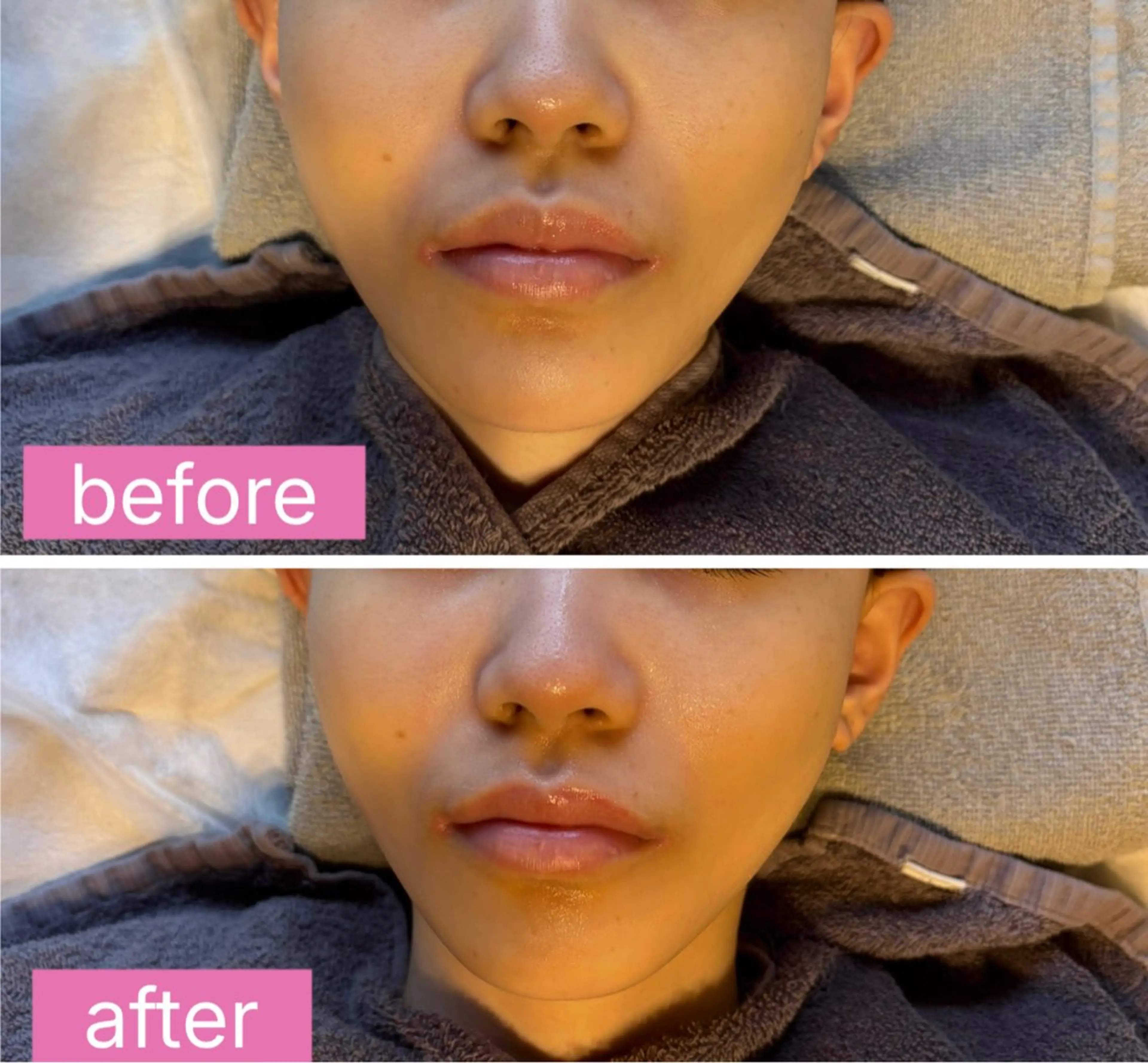 DNA小顔フェイシャル(小顔、中顔面短縮、リフトアップ、たるみ)の写真