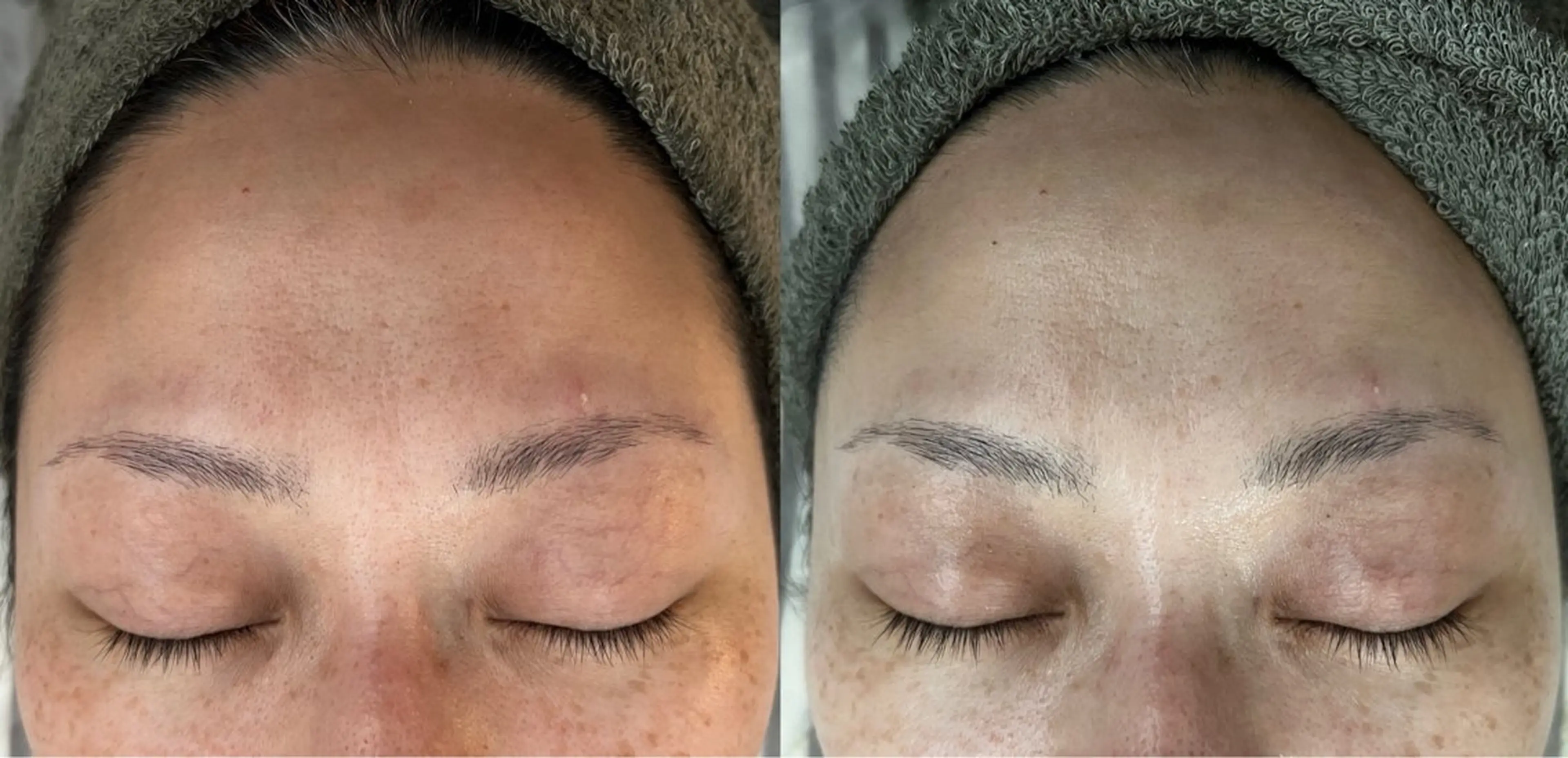 【透明感・ツヤ肌ケア・くすみ】REVIハーブピーリング🌿陶肌トリートメント＋VCF0.8mlの写真