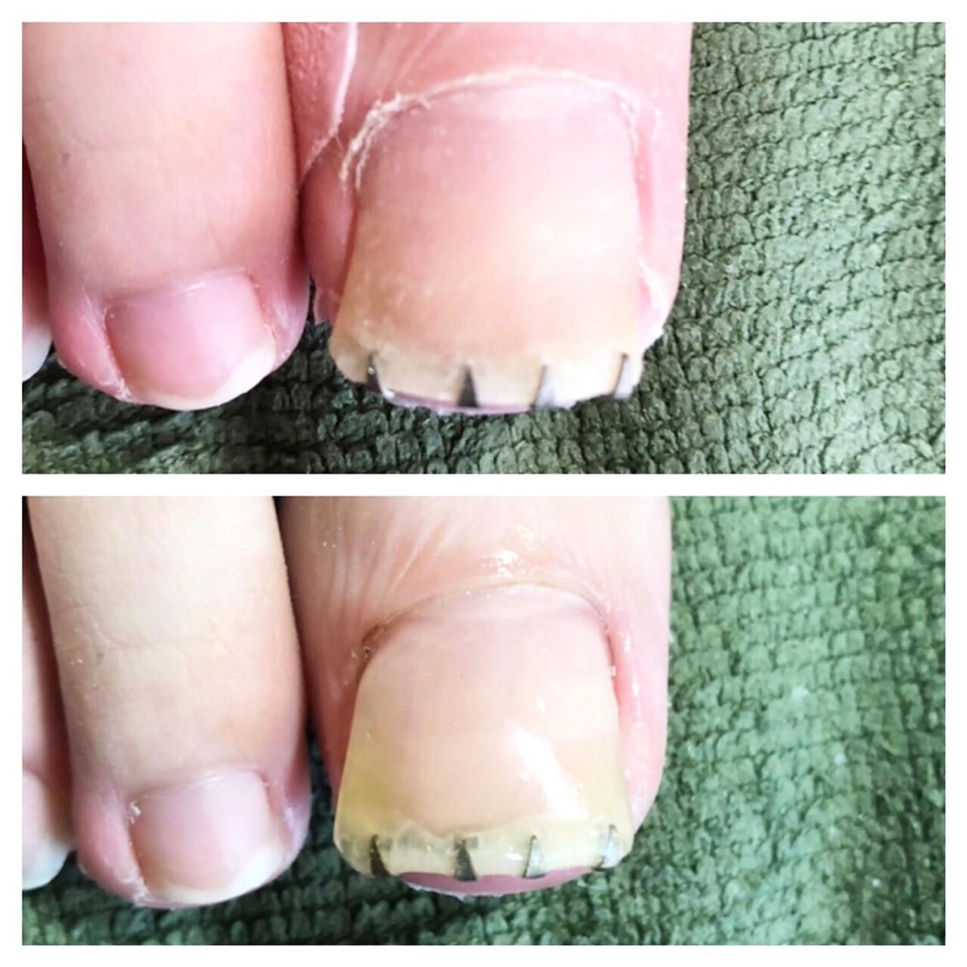 ショート カラー メンズ キッズ ネイル アートネイル クリアネイル フットネイル ジェルネイル 赤色 その他 フットケアサロンすりーぴんぐ田端店所属・🌱 ま　し　お　🌱のエステ・リラクイメージ