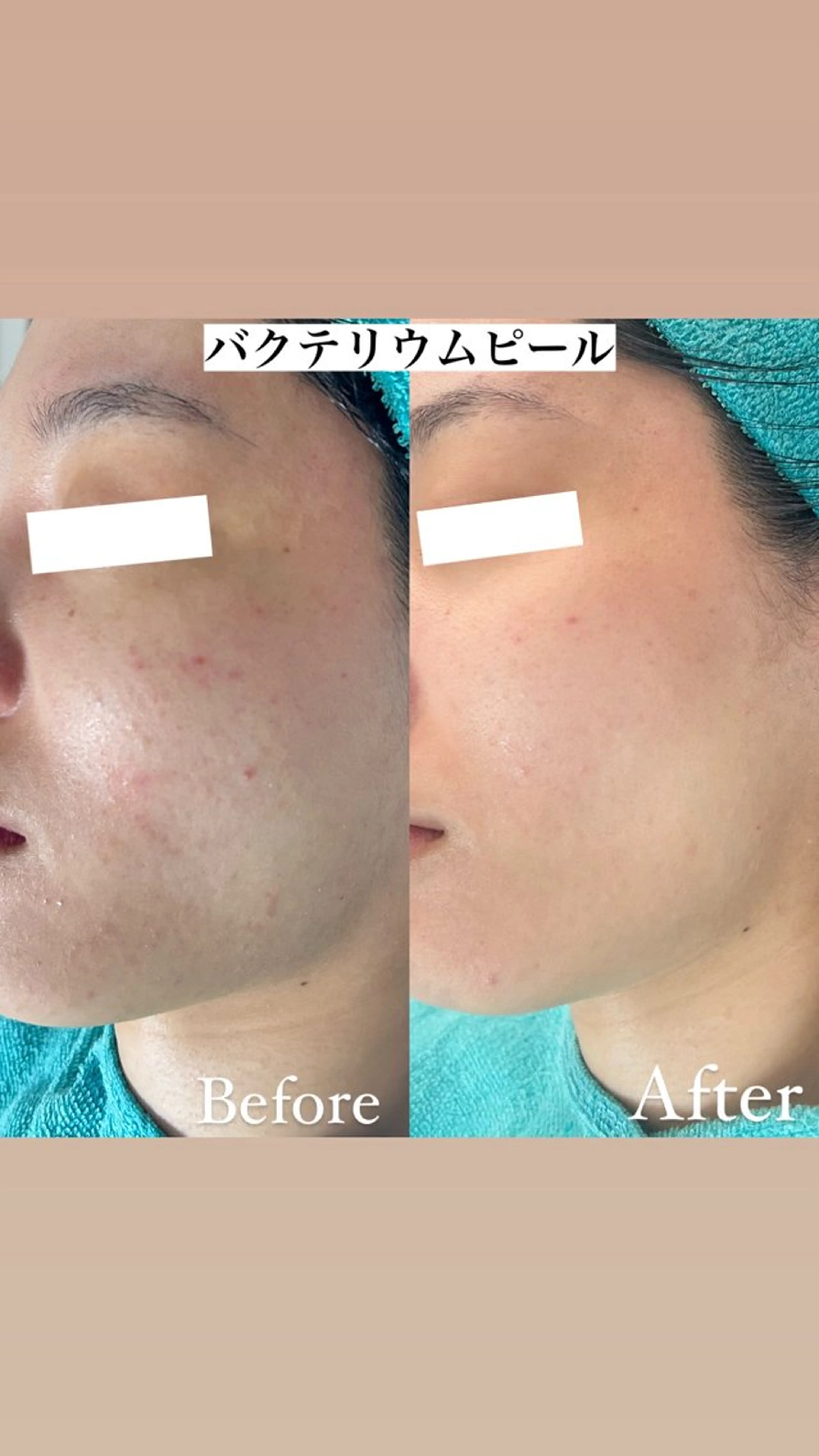 エステ 都度払い制脱毛サロンBe Charm所属・Be Charm 山﨑のエステ・リラクイメージ