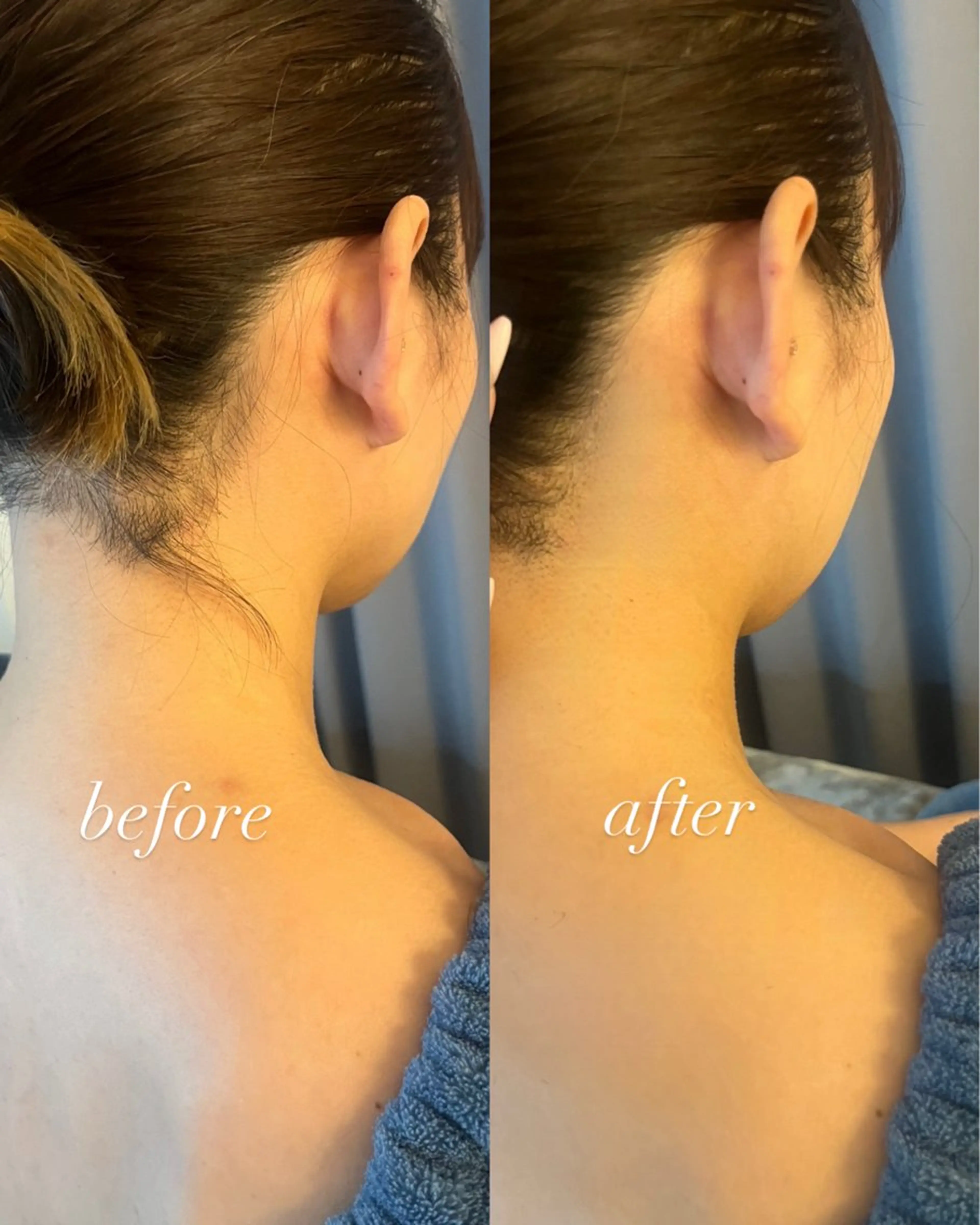 脱毛 うなじ脱毛/美肌脱毛 LABELのエステ・リラクイメージ