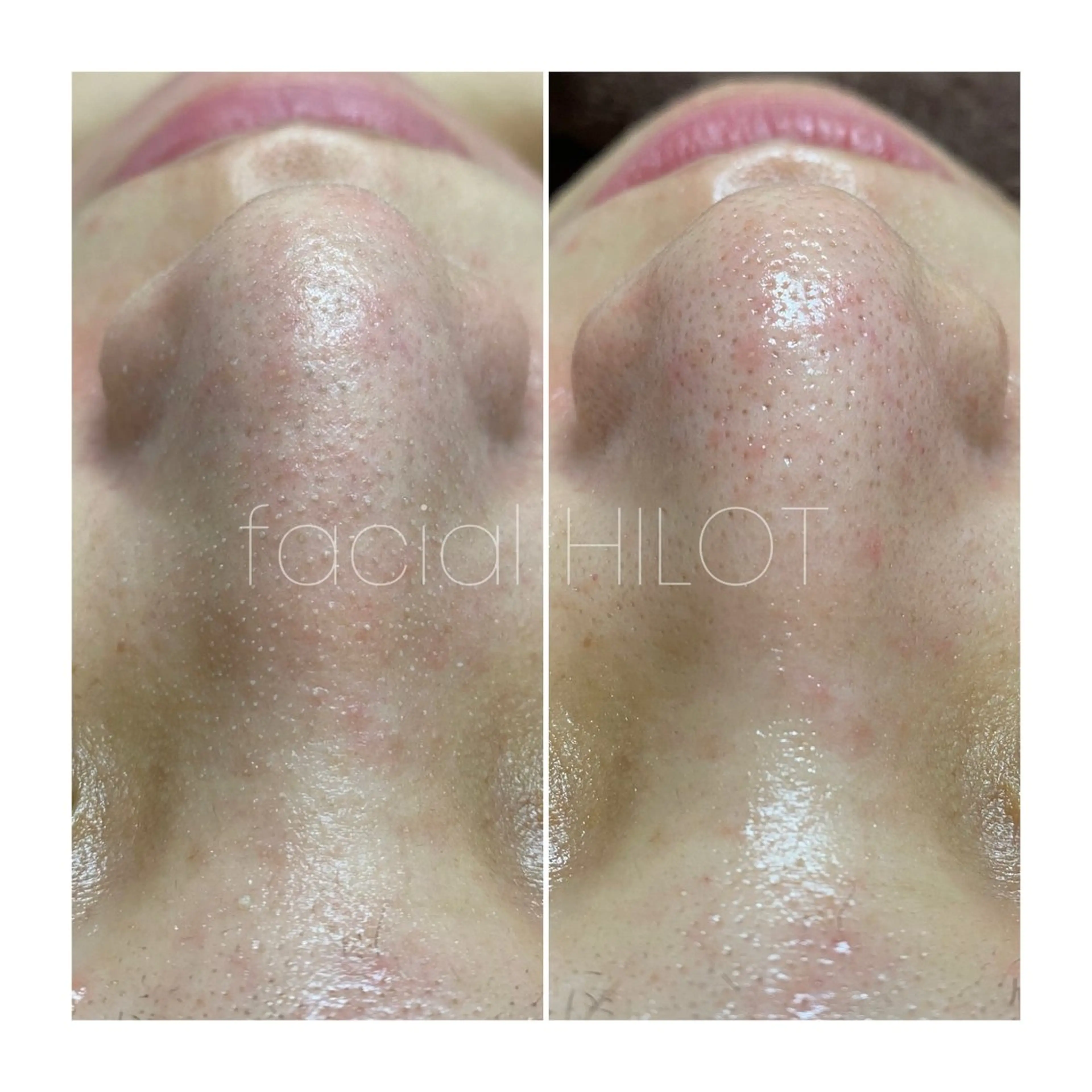 Sugaring / HILOT TAOのエステ・リラクイメージ