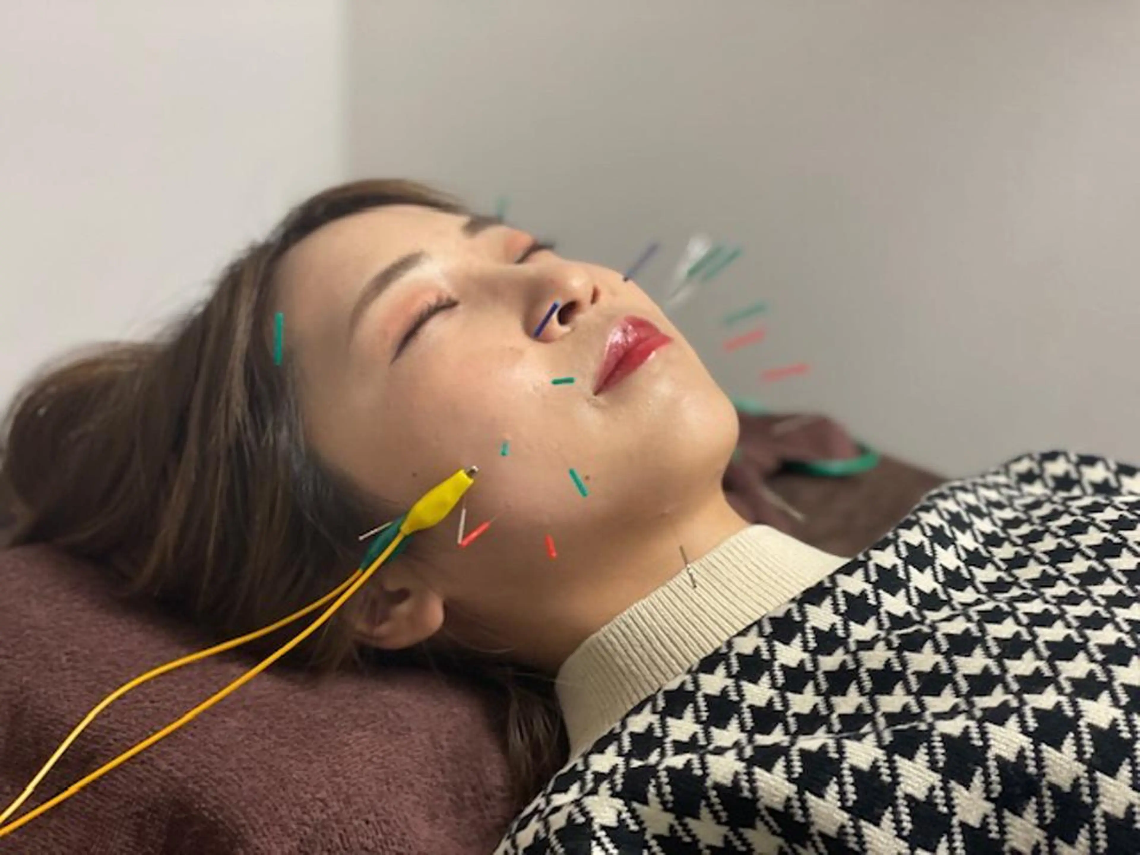 【リフトアップ】💐電気美容鍼(針)＋ローラー鍼＋首のマッサージ💐の写真