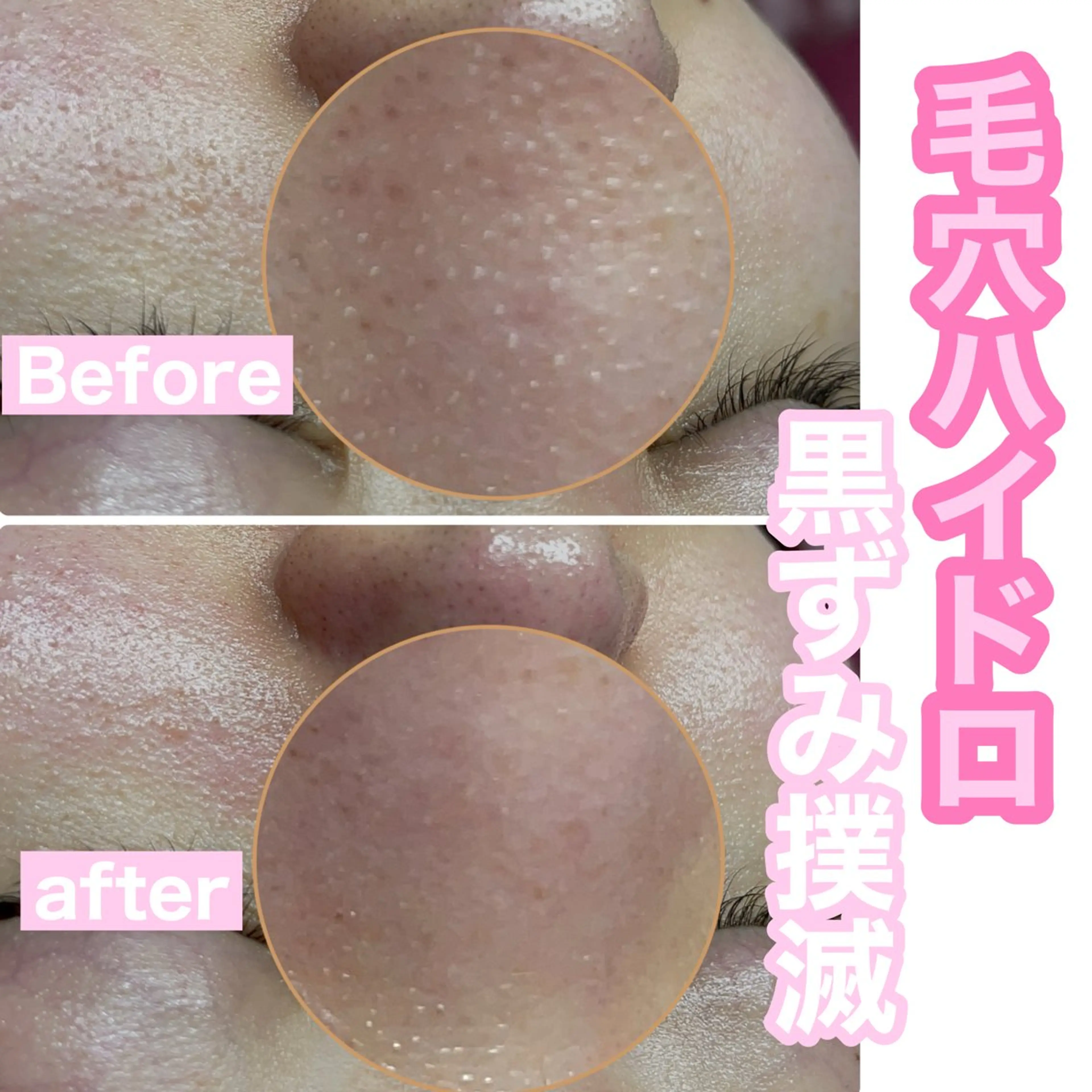 エステ Chalon所属・REVI取扱・肌悩み 毛穴Chalonのエステ・リラクイメージ