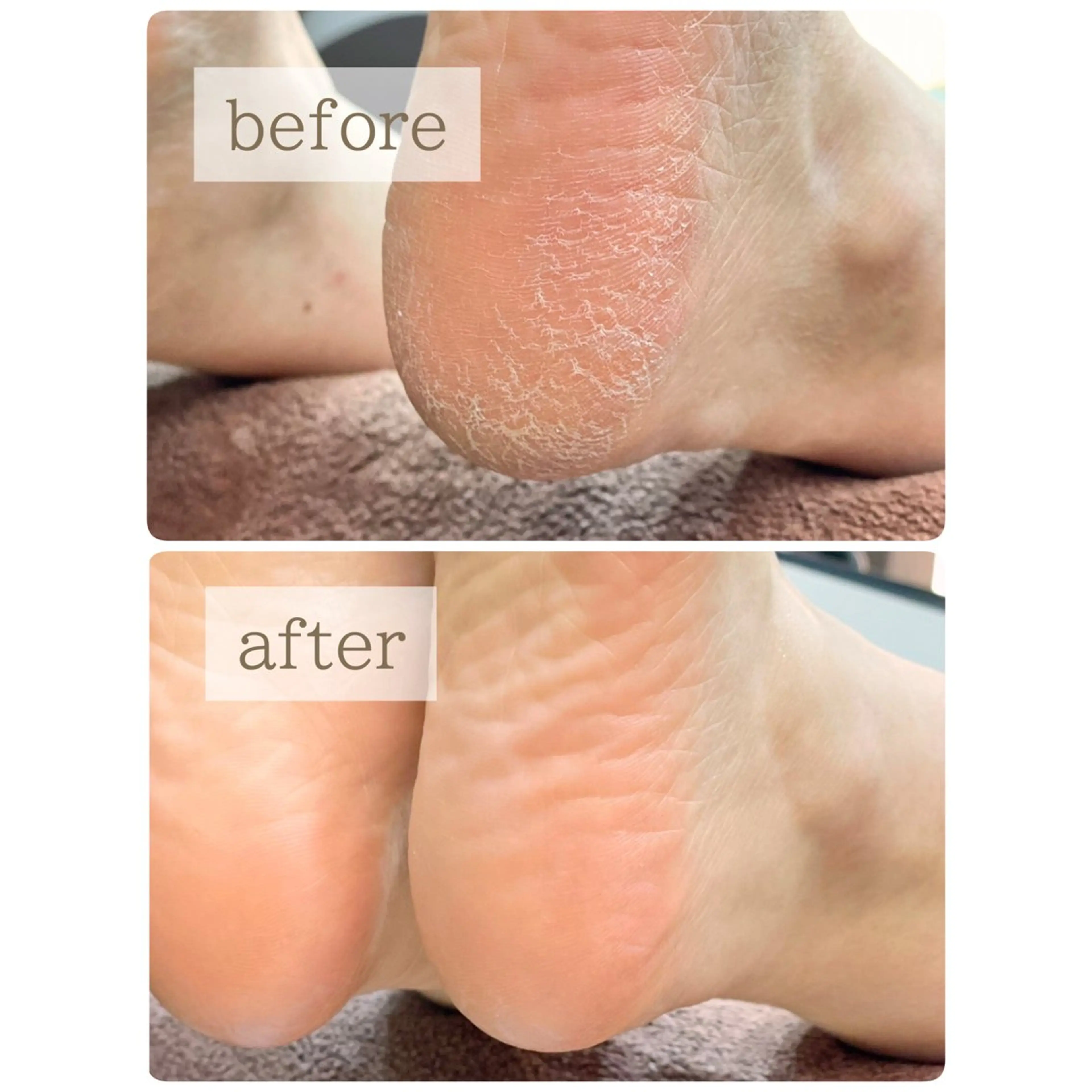 ⭐️フット角質取り-素足美人コース⭐️の写真