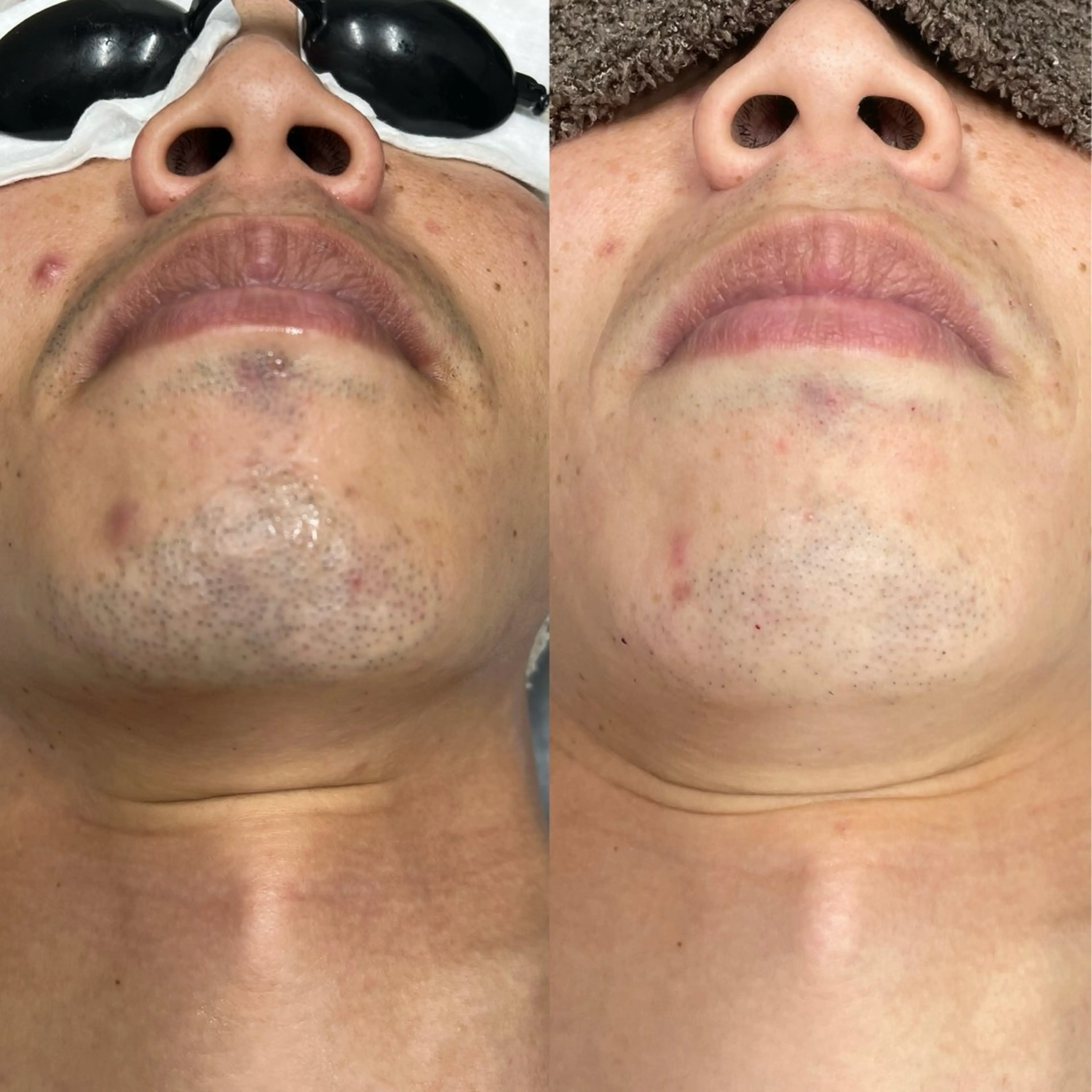 青ひげ解消！ヒゲ脱毛👔の写真