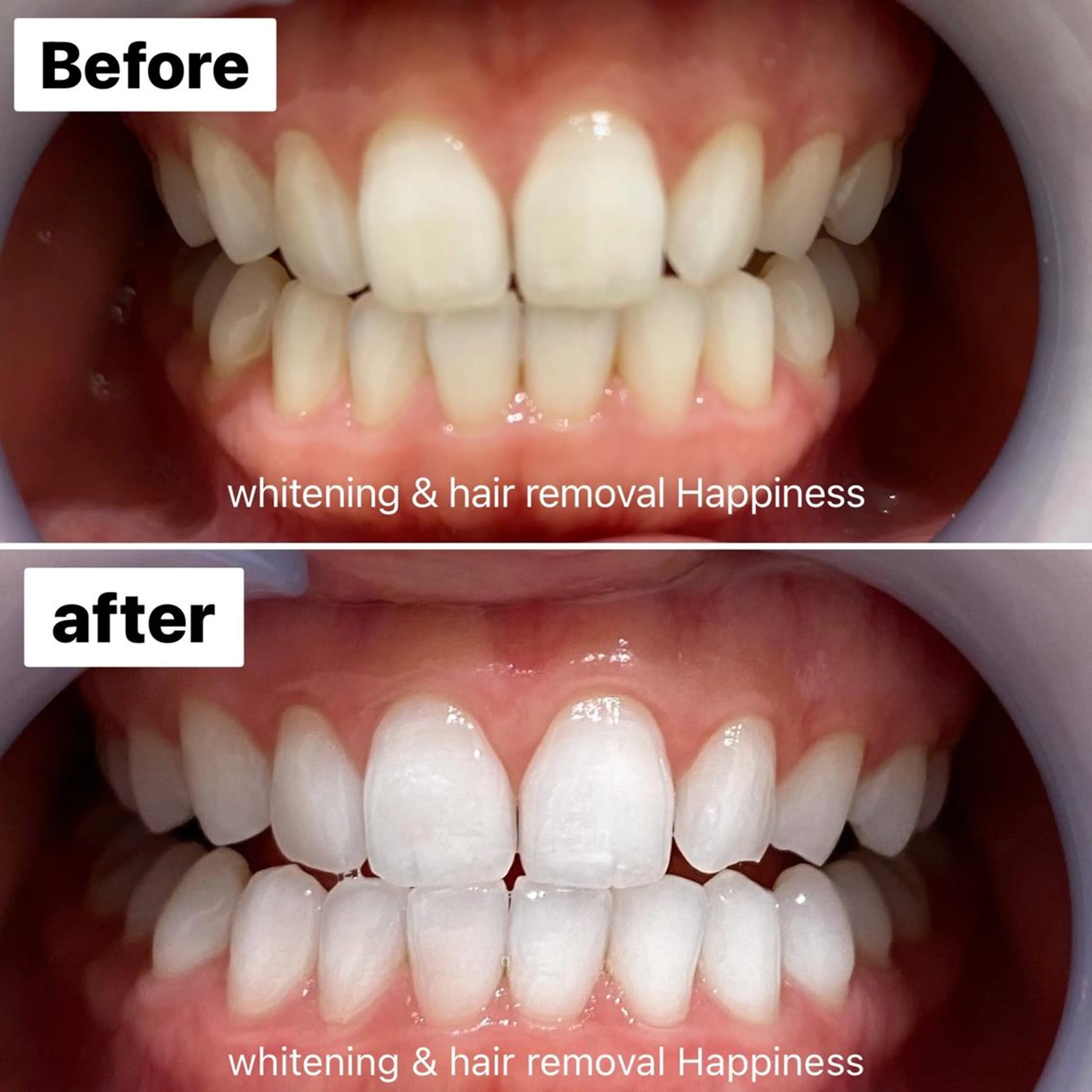 【口コミ割引】💎プレミアムホワイトニング💎15分×3回／4 5分照射6000円→5480円の写真