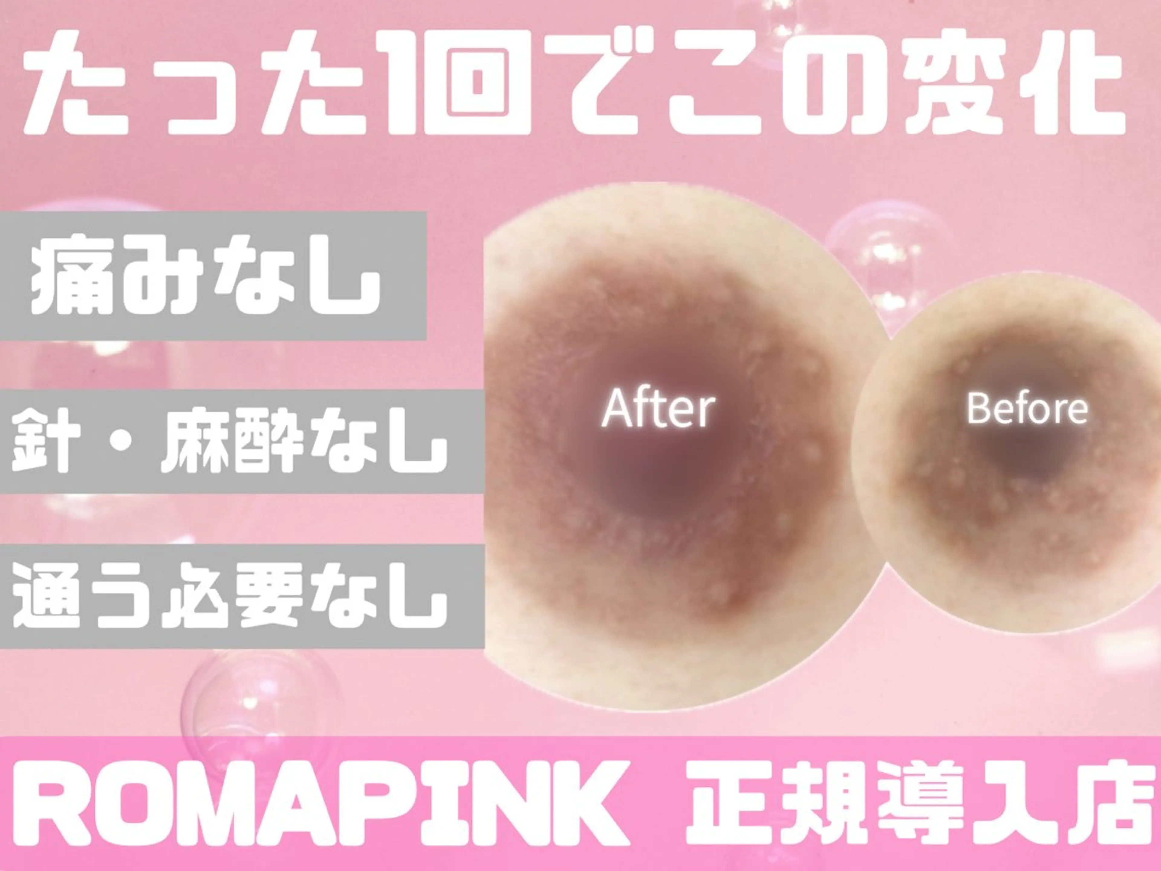 【黒ずみ/メラニンケア】ローマピンク無料カウンセリングの写真