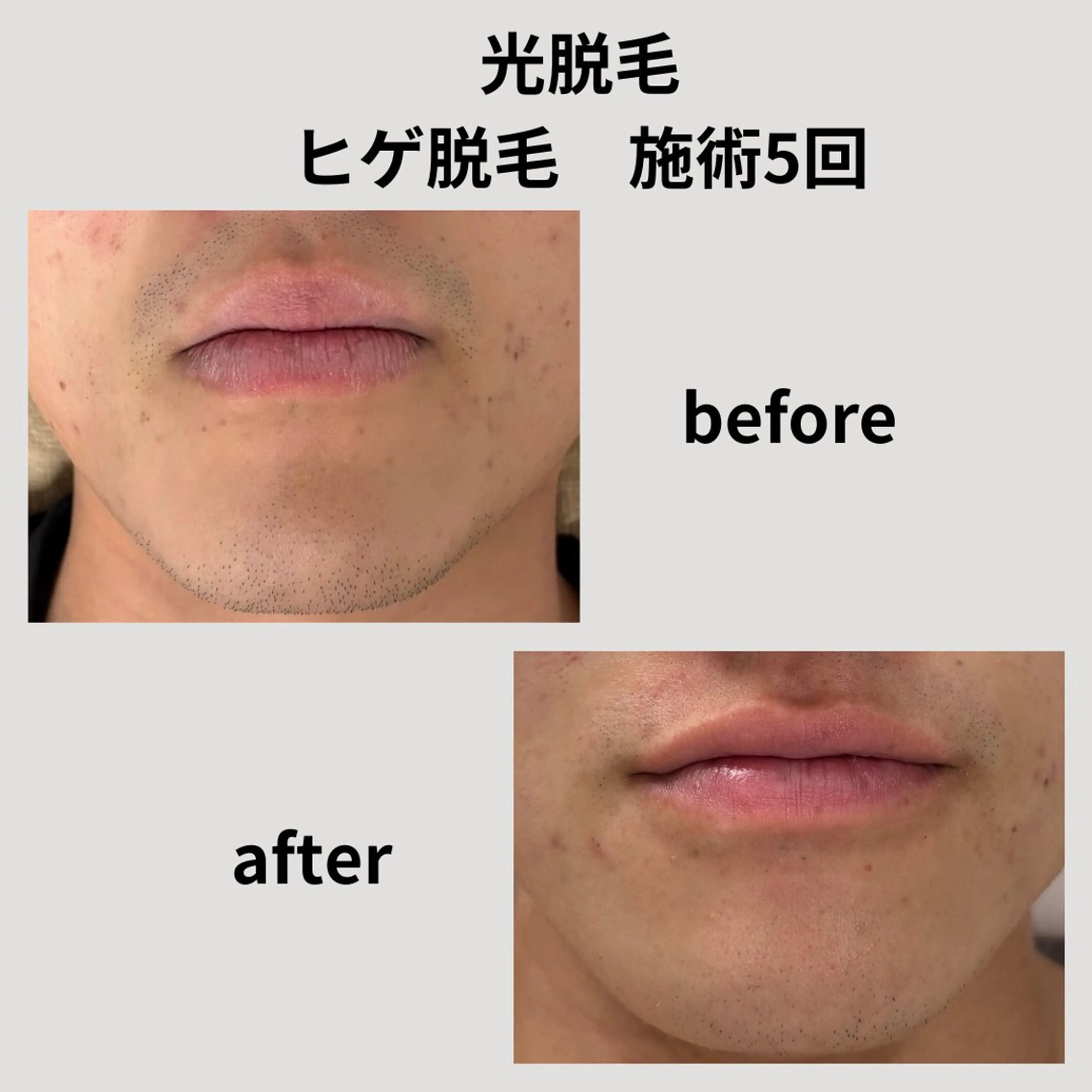 メンズ 脱毛 脱毛＆フェイシャル H'euriaのエステ・リラクイメージ