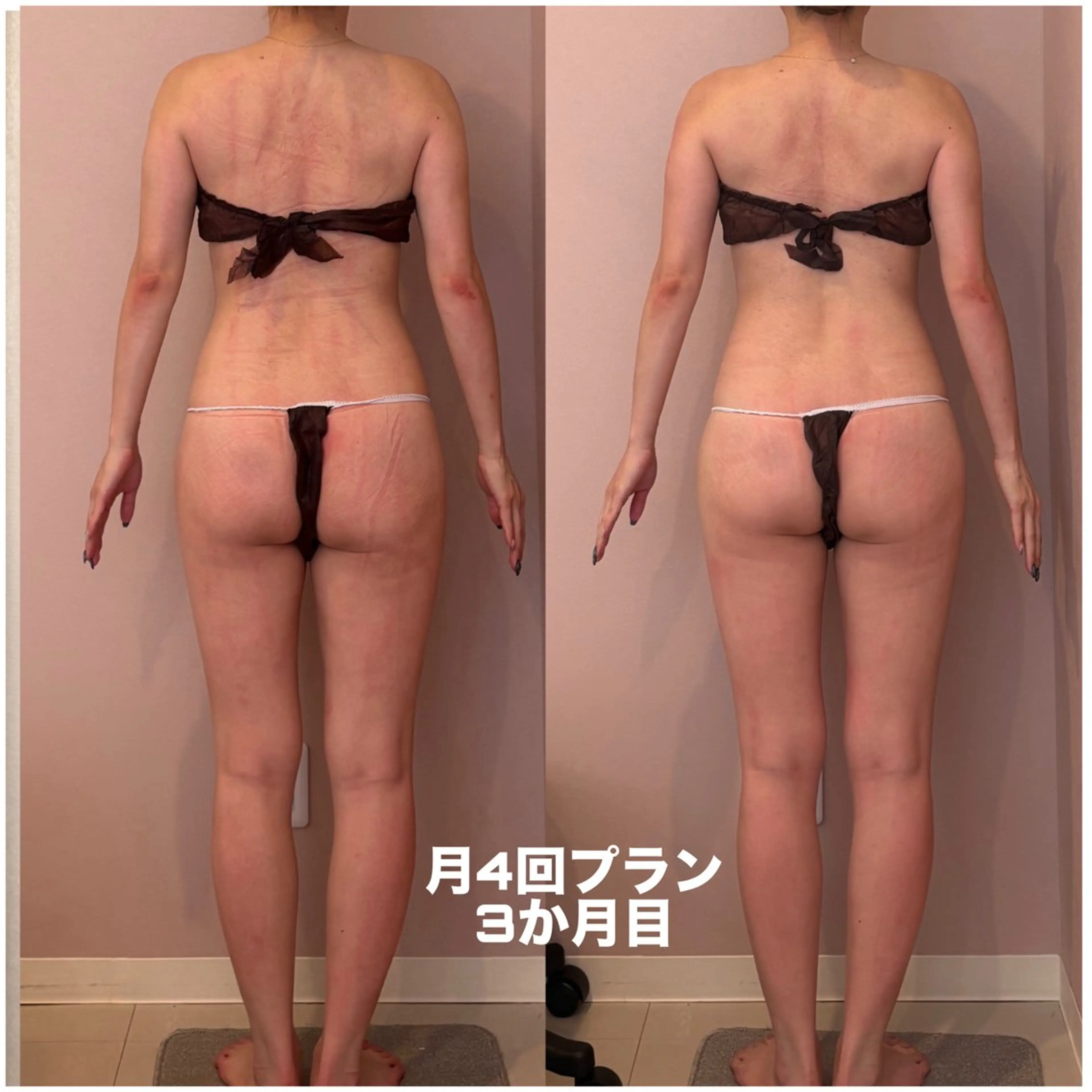 【姿勢美人 骨膜リリース】猫背・巻き肩・反り腰改善で“後ろ姿”が変わる!の写真