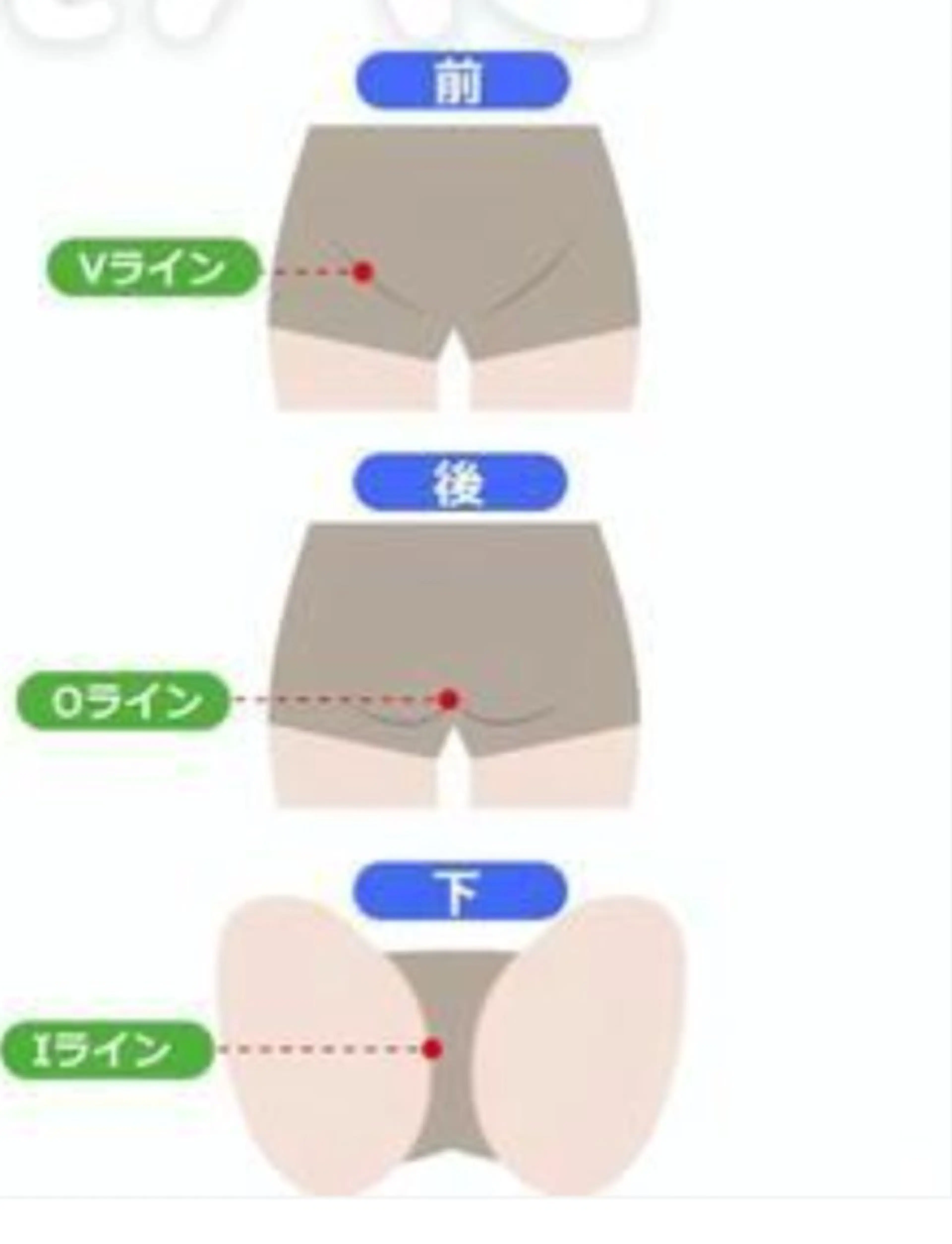 メンズ脱毛　　VIO    どうしても無くならない◯◯の裏とか。しっかりケアしましょう！の写真