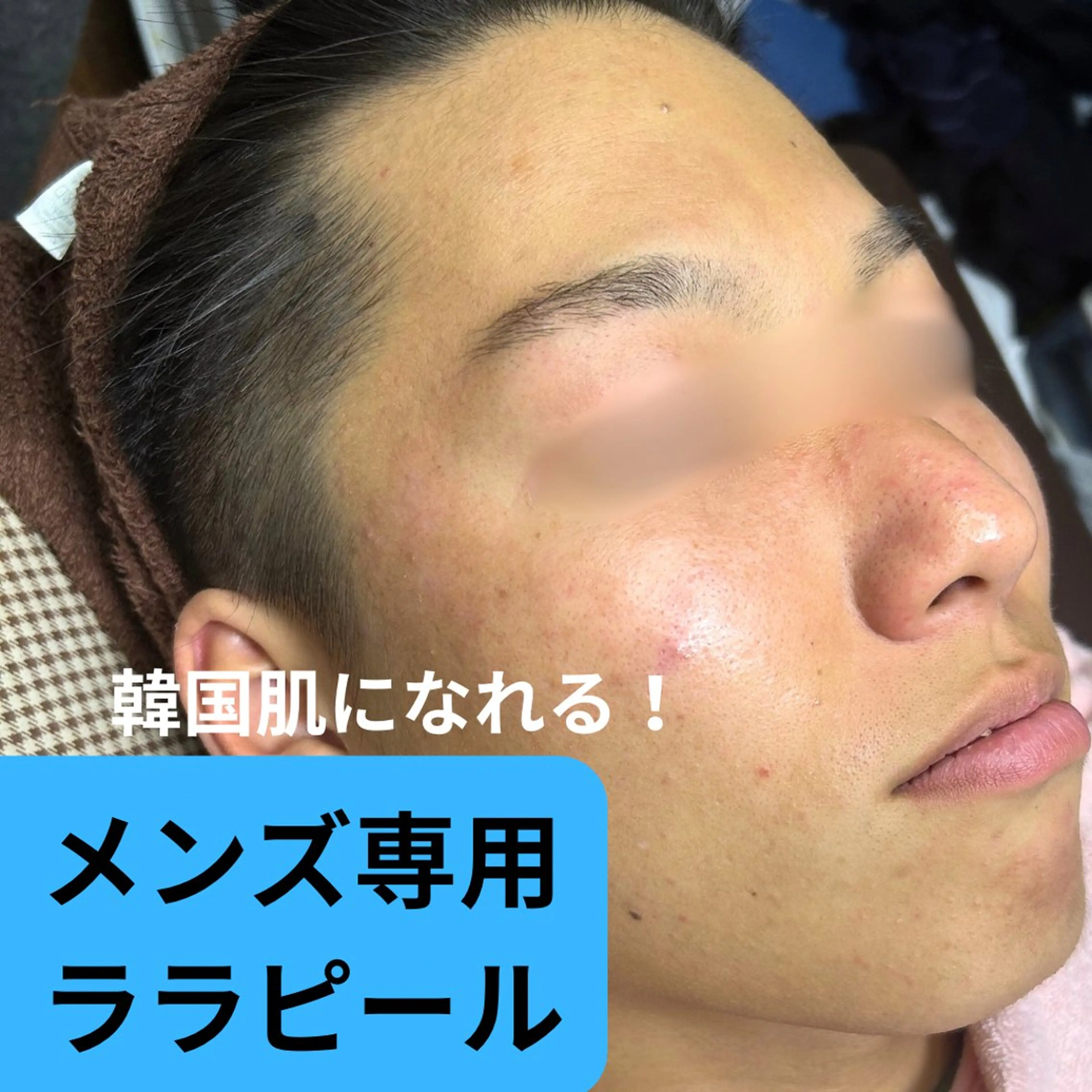 【男性専用　韓国肌ララピール】SNSで大人気！第4世代ピーリング毛穴/美白/ニキビ/ニキビ痕‥◎完全個室なのも◎男性3割の写真