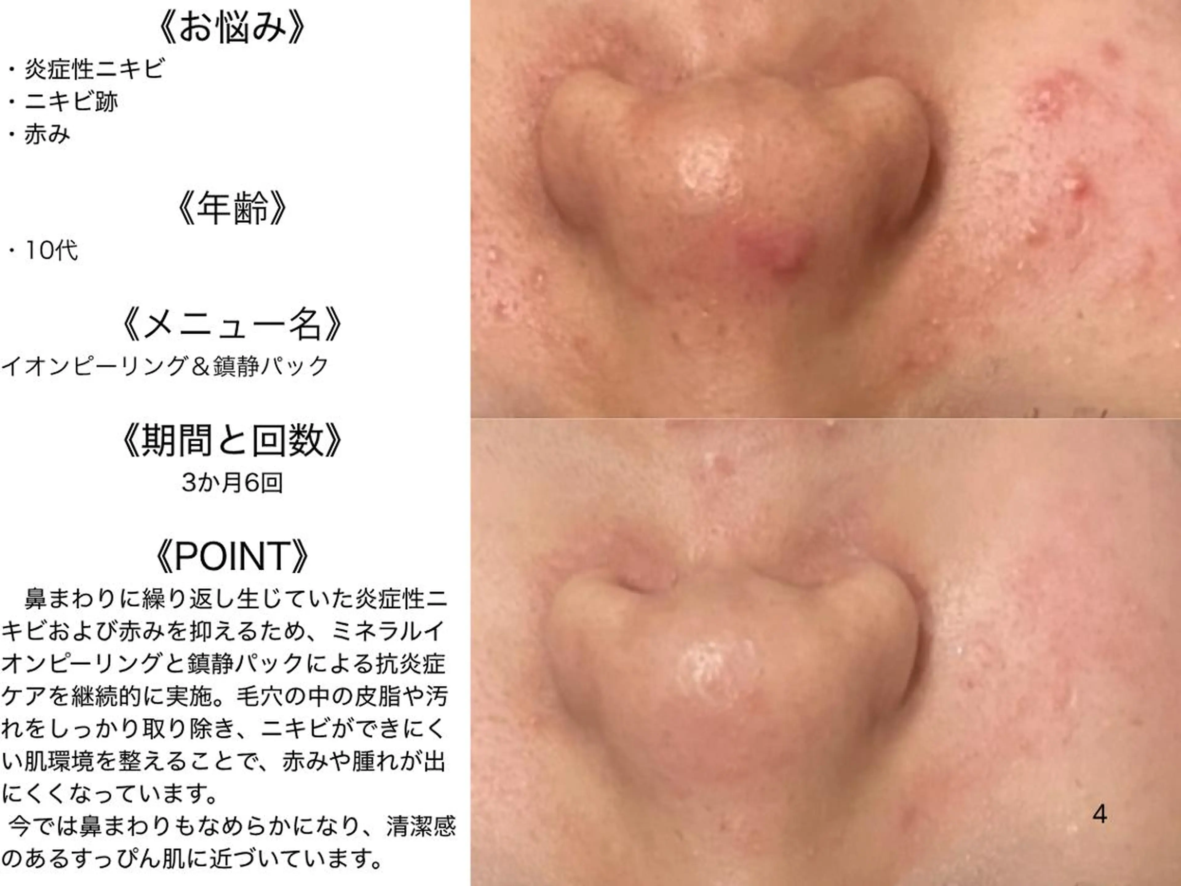 エステ リラク 3か月で肌革命👼 ニキビ専門店💫のエステ・リラクイメージ