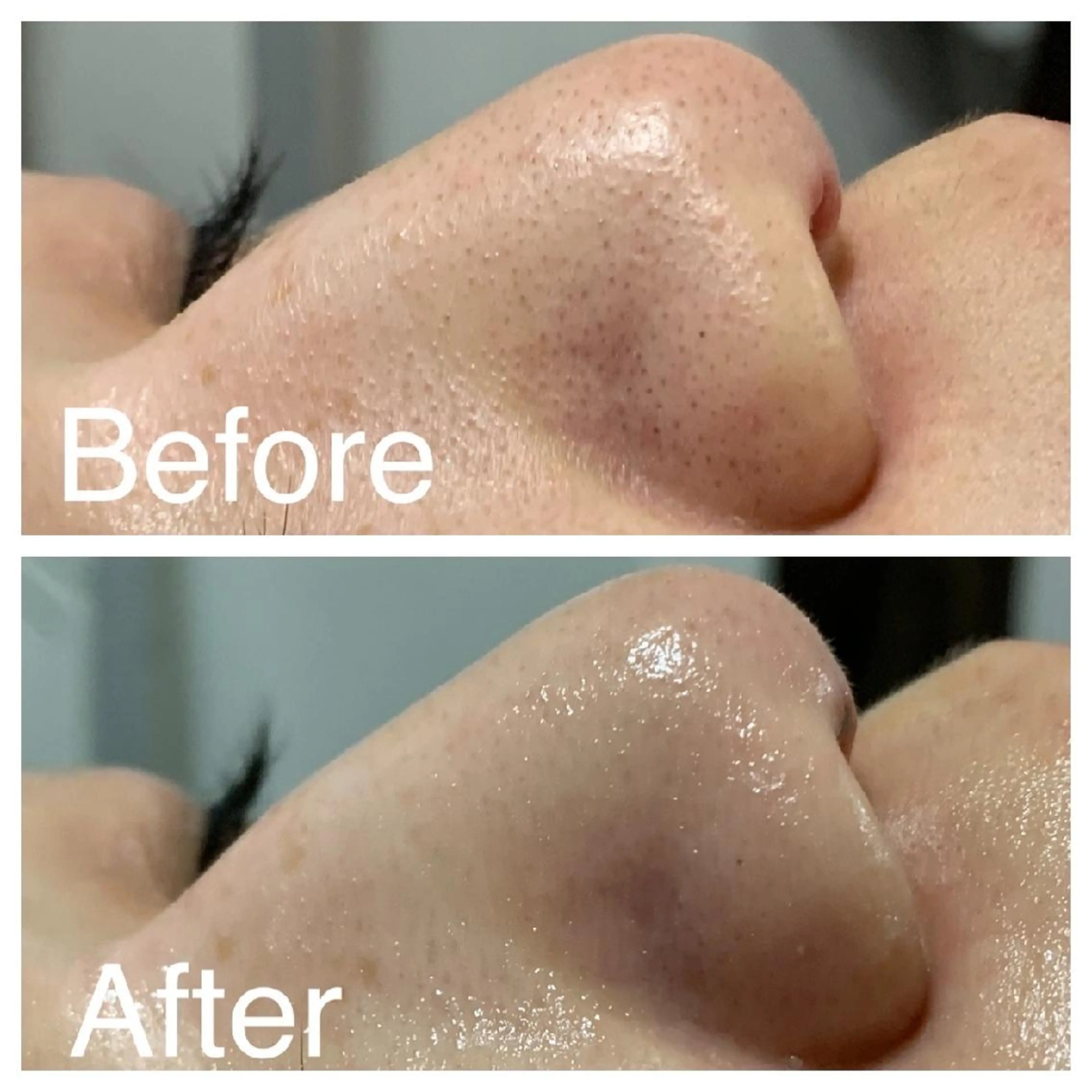 医療提携Ruby小顔 ハーブピーリングのその他イメージ