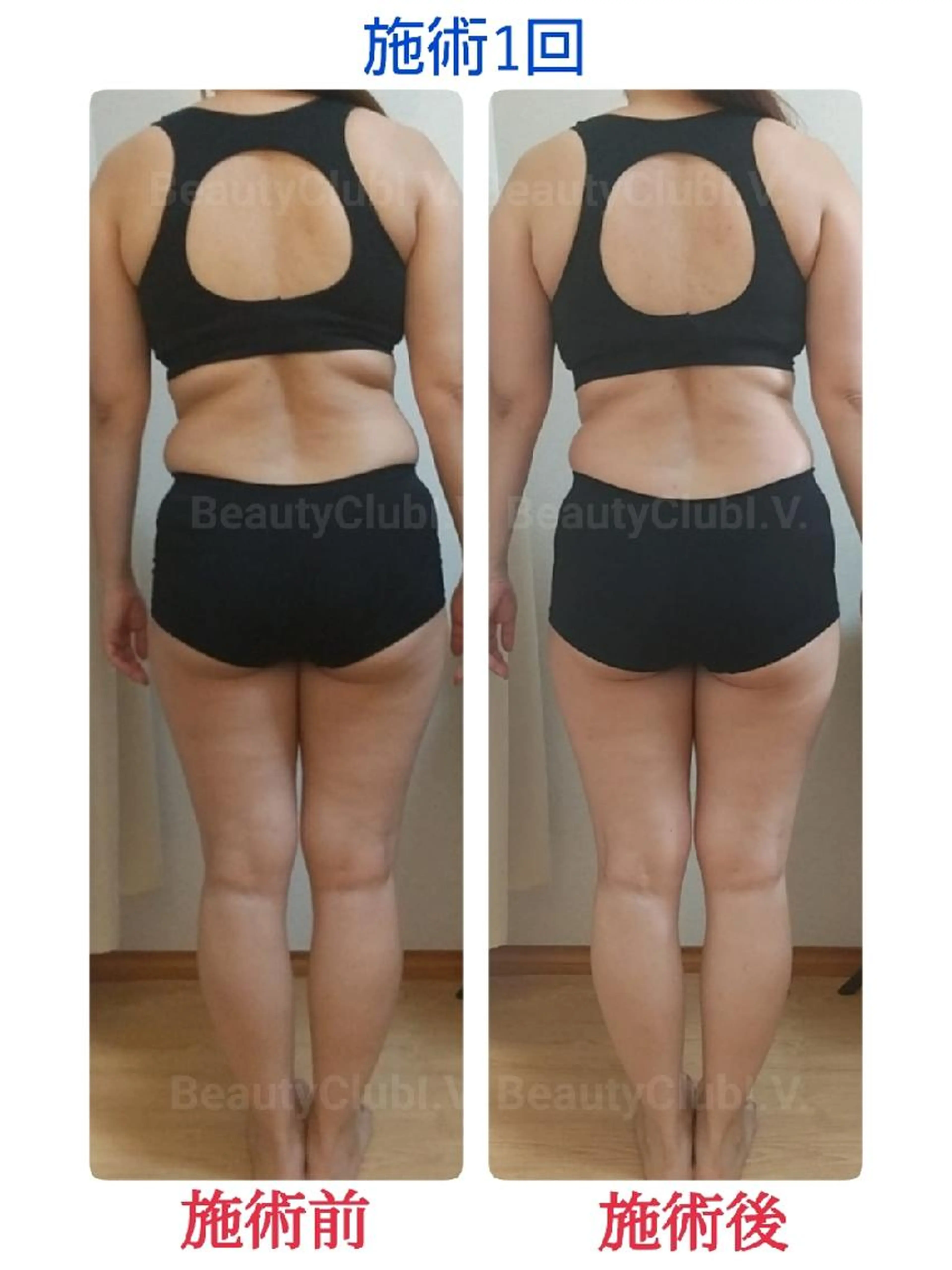 【結果重視】痩身エステ～筋膜リリース～の写真