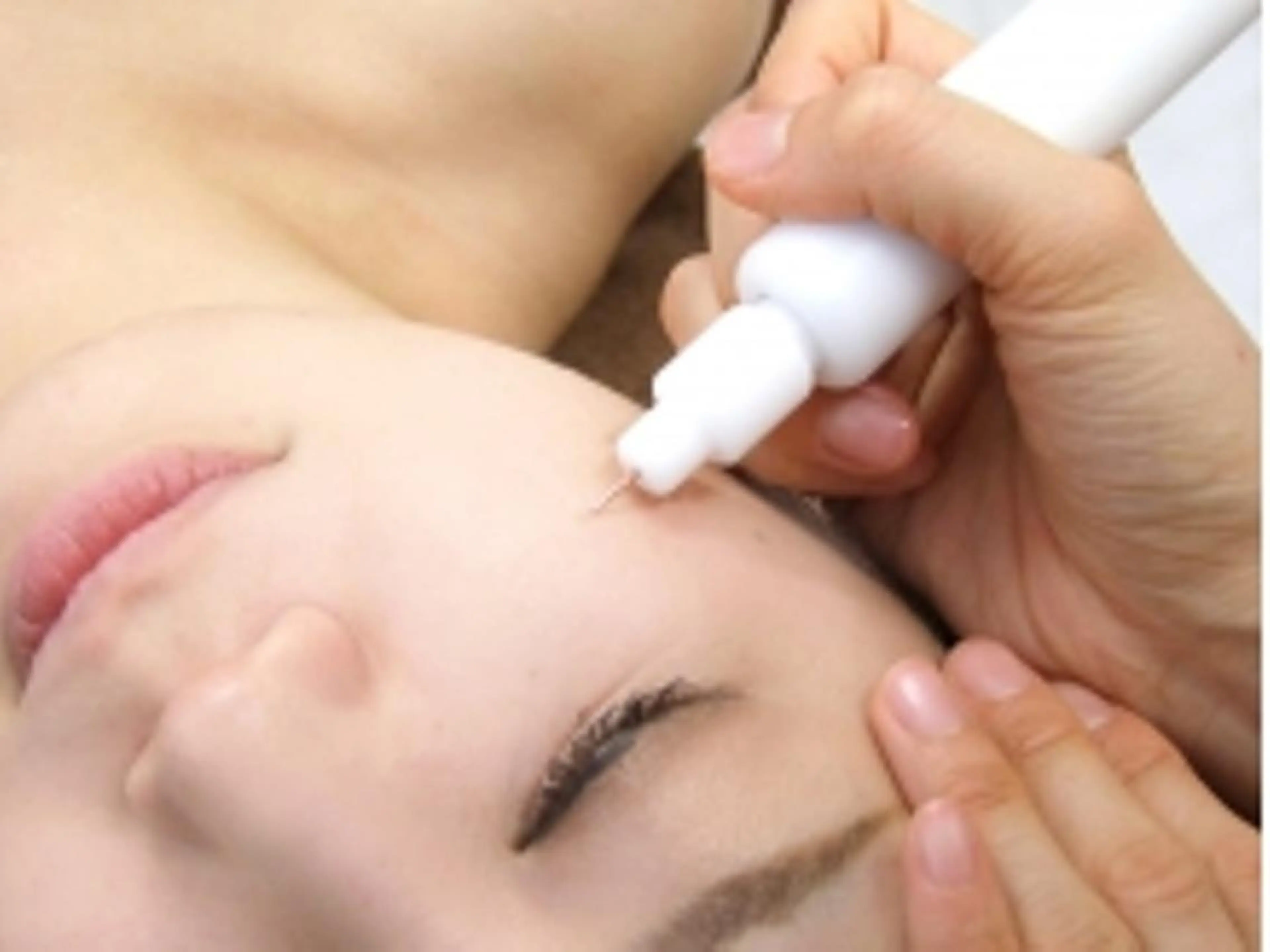 【シミを作りにくい肌へ！シミ改善フェイシャル】シミケア5個分¥22,000→¥9,900※補足説明をご一読下さい。の写真