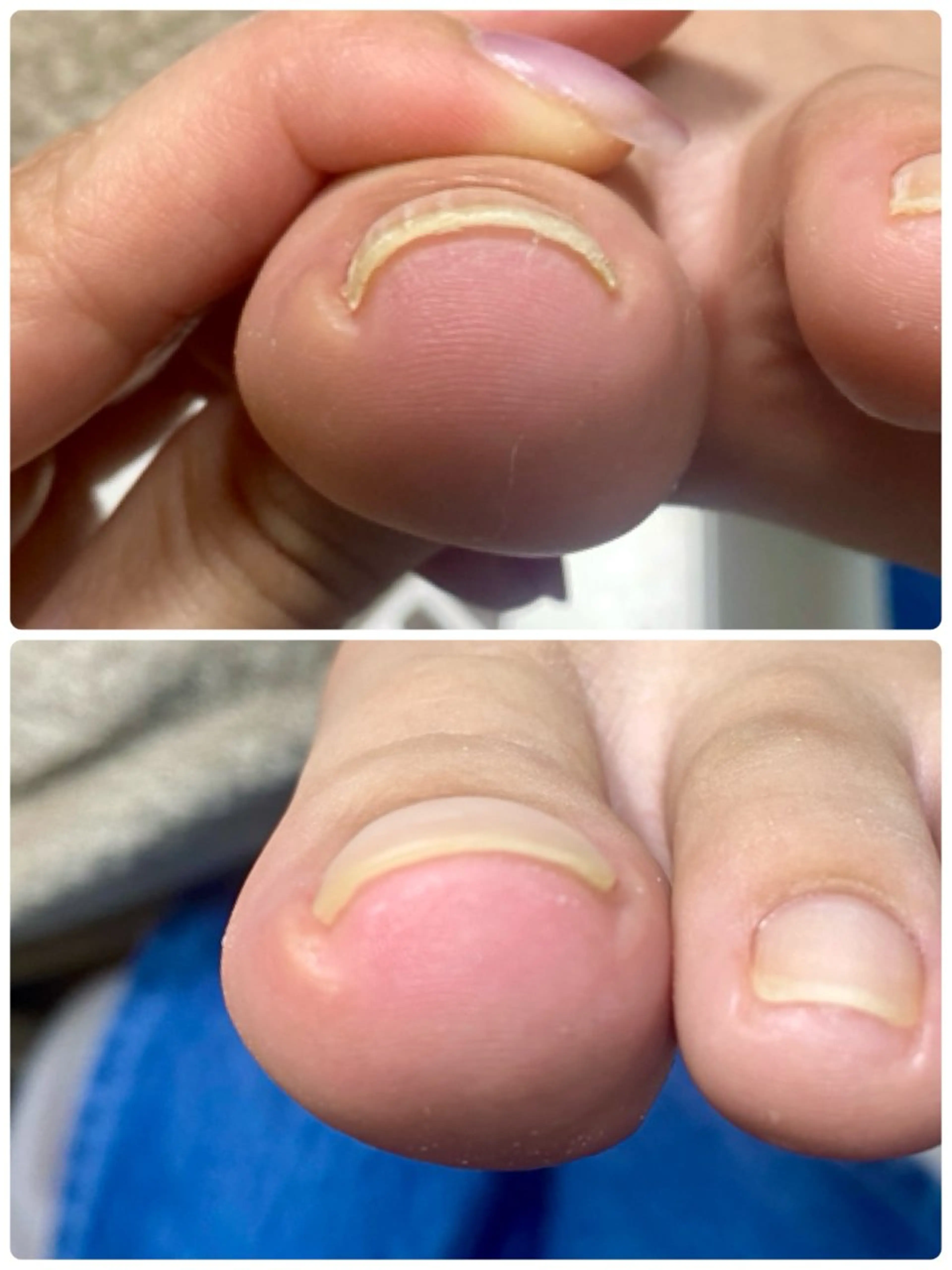 ネイル フットネイル スカルプネイル フットネイル 自爪育成nail fachuriのネイルデザイン