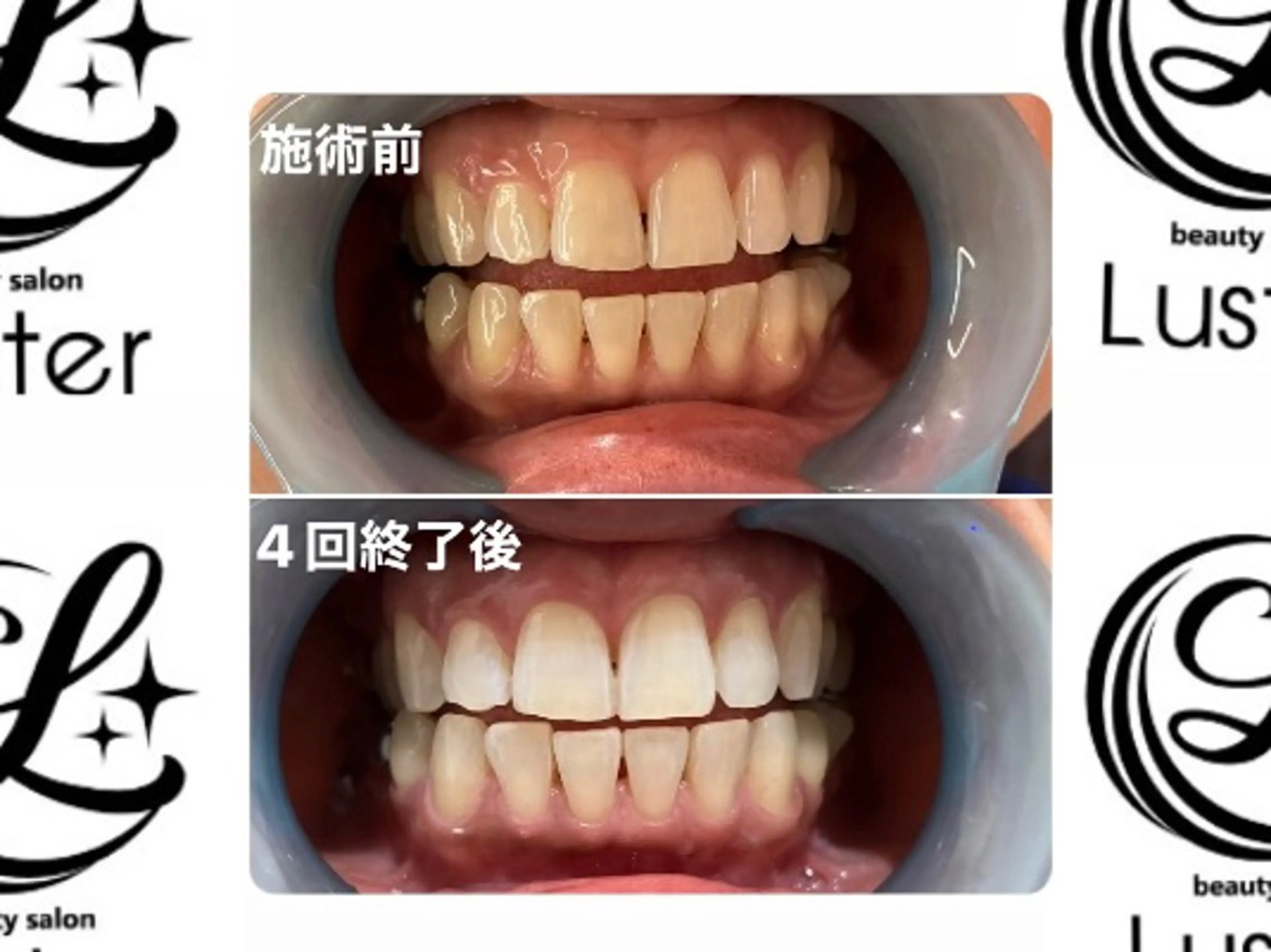 セルフホワイトニング 『Luster』のその他イメージ