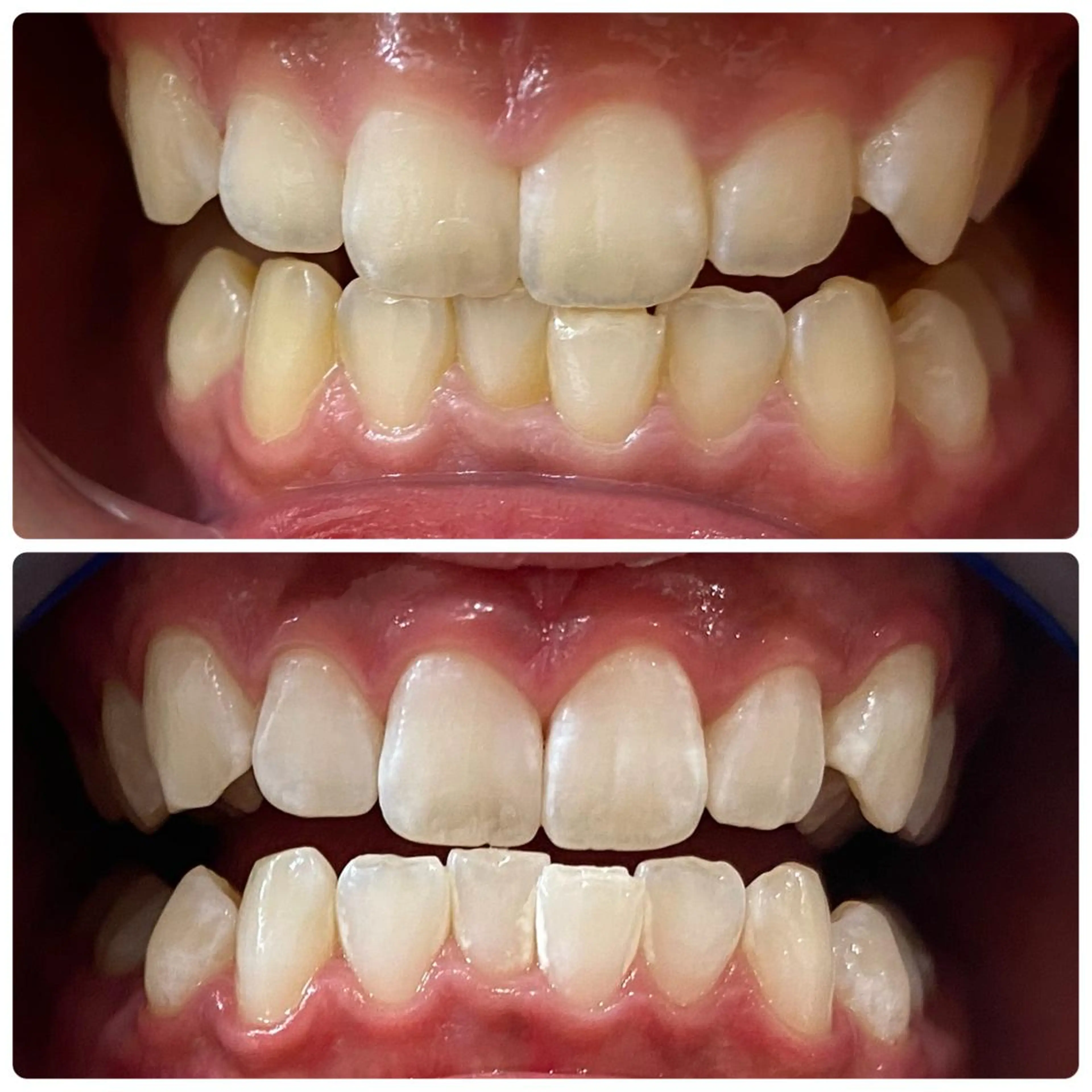 その他 セルフホワイトニング 🦷口元垢抜け✨のその他イメージ
