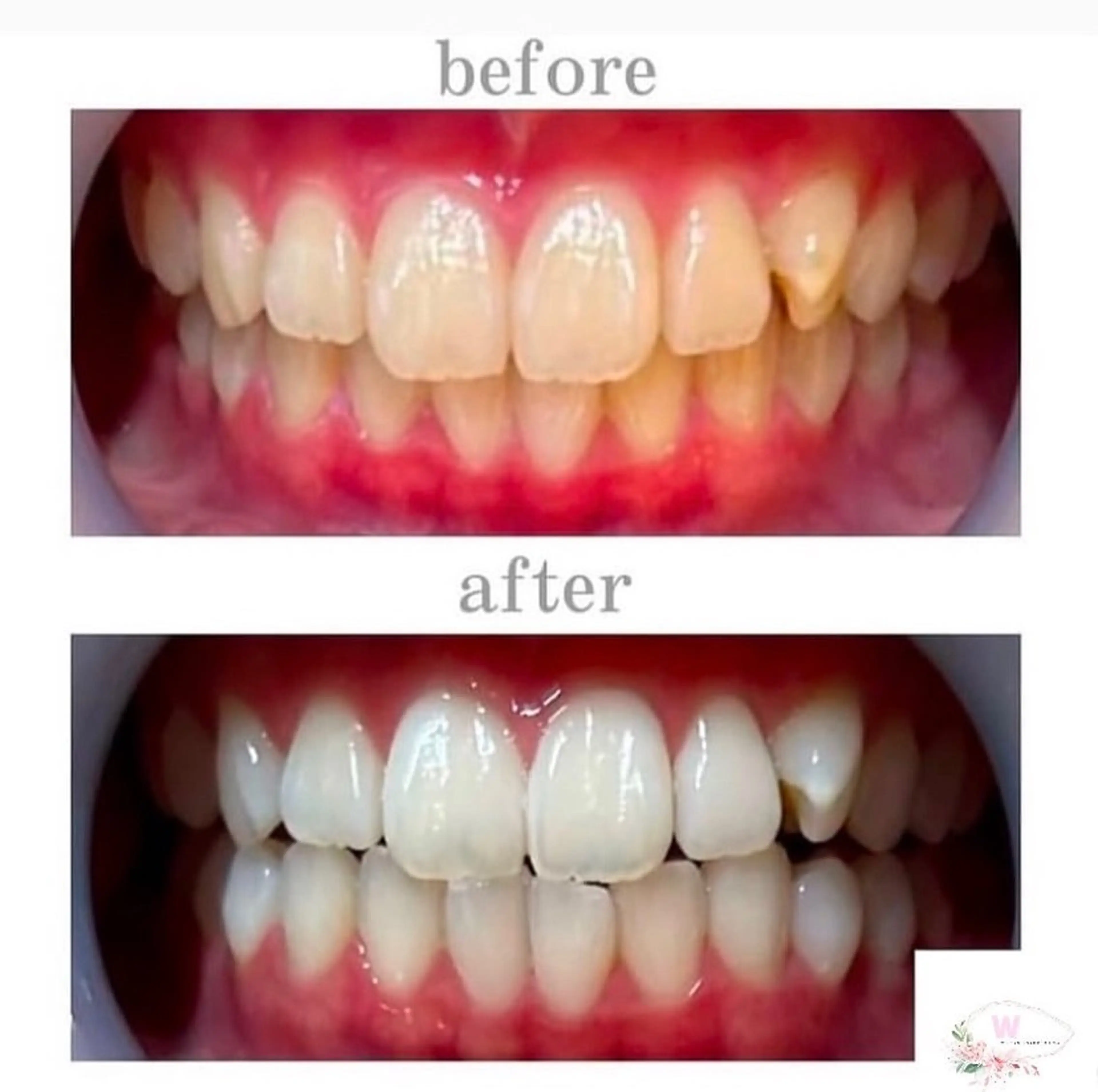 1番人気❤️VIPホワイトニング20分×２回🦷🫧¥7,980▶︎¥4,980💖の写真