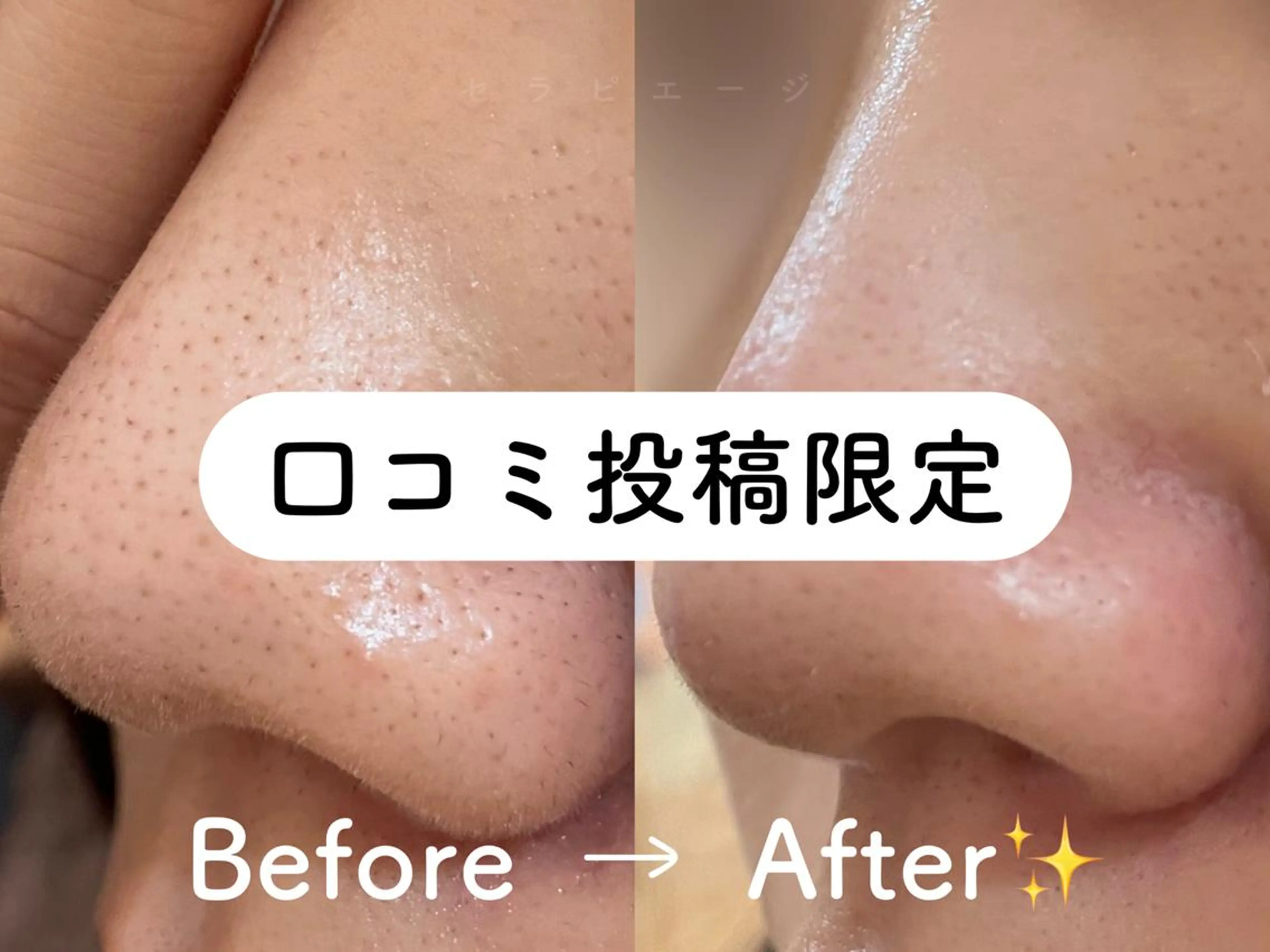 【毛穴黒ずみごっそりキレイ❤️🔥✨】毛穴洗浄ハイドラフェイシャル【口コミ投稿限定価格】の写真