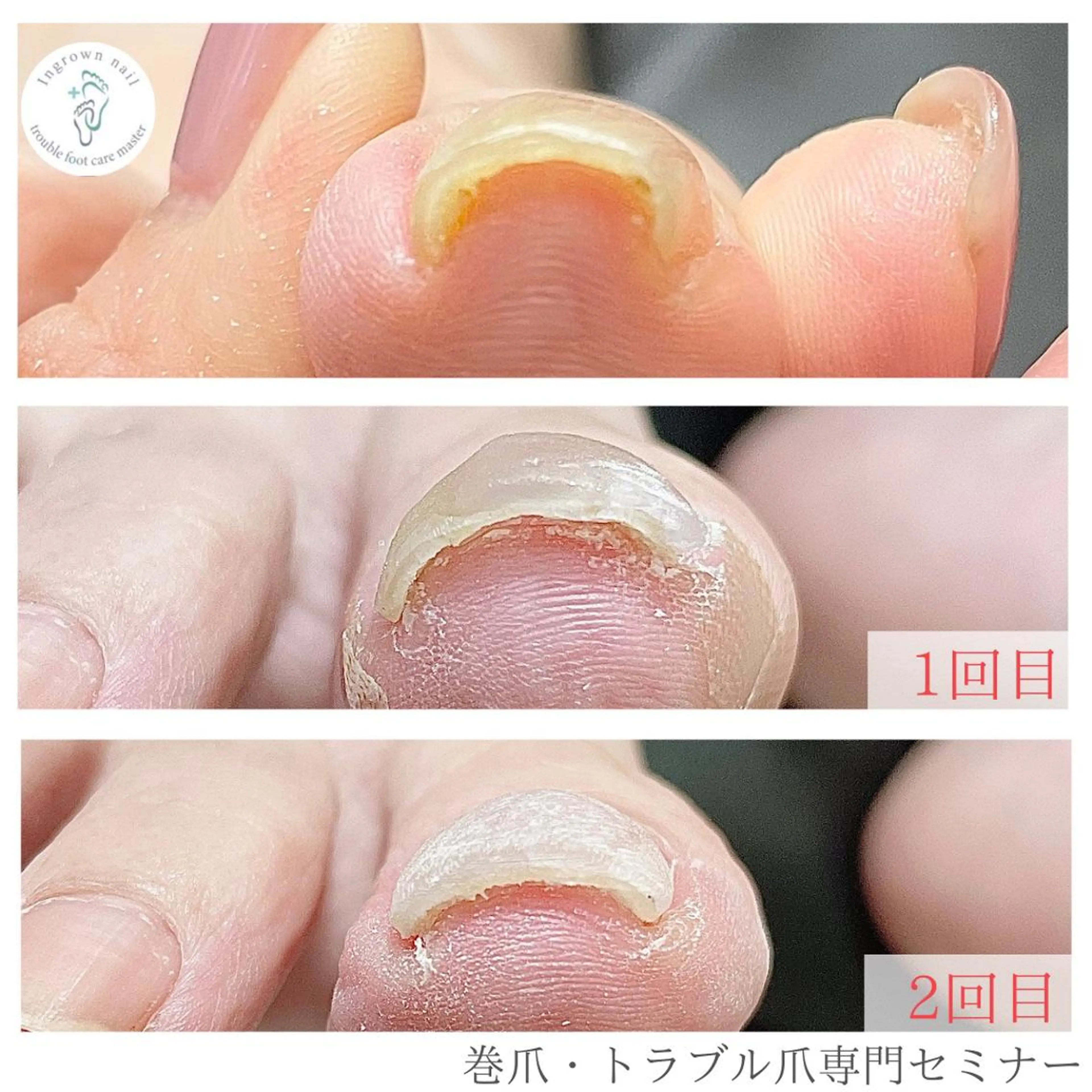 ネイル 深爪・巻き爪 専門サンセリテのネイルデザイン