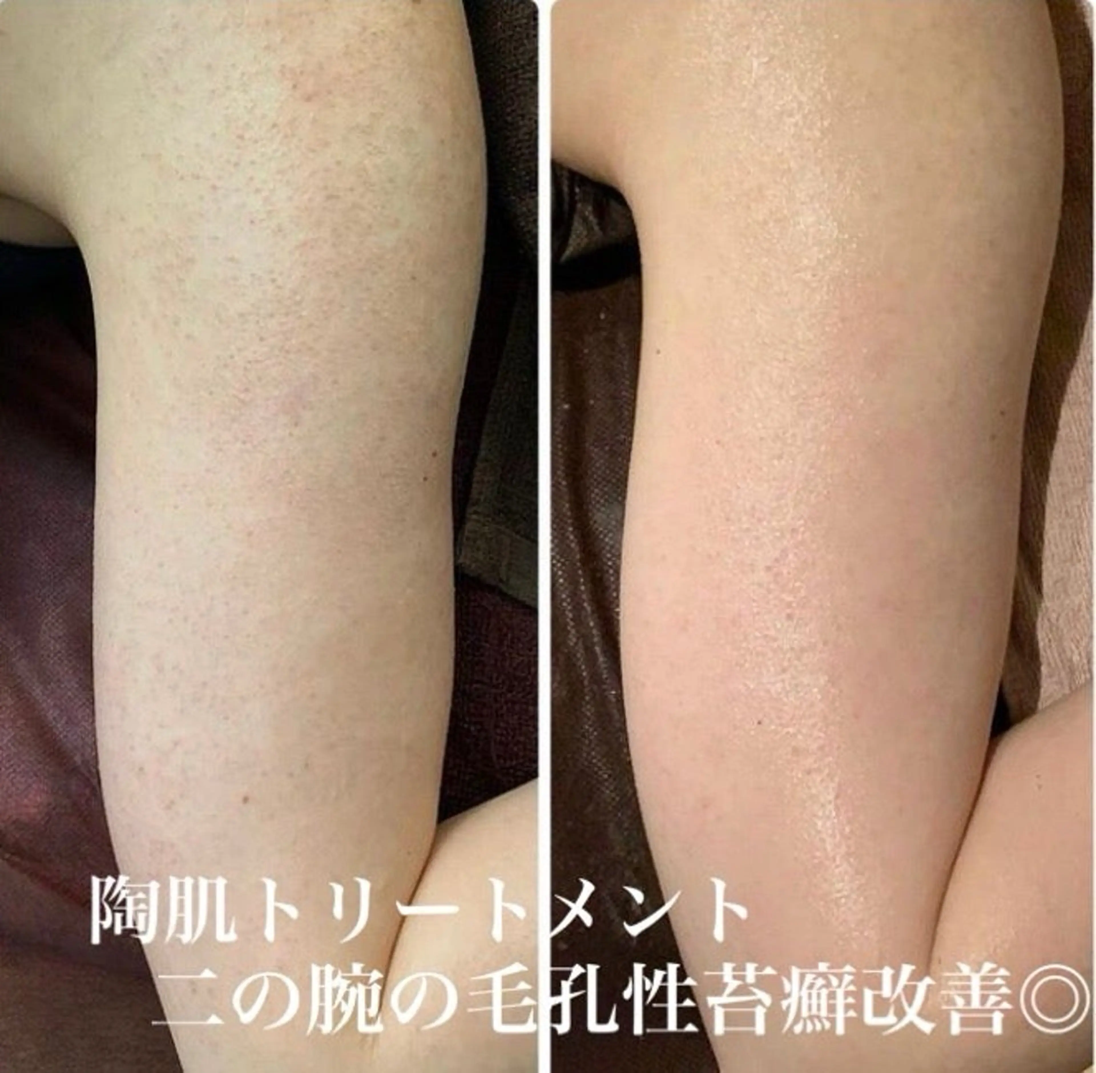 ハーブピーリング/韓国肌管理/フェイシャル/毛穴洗浄/眉毛/顔脱毛【糸脱毛専門】rev所属・ハーブピーリング専門 毛穴洗浄❤️眉waxのエステ・リラクイメージ