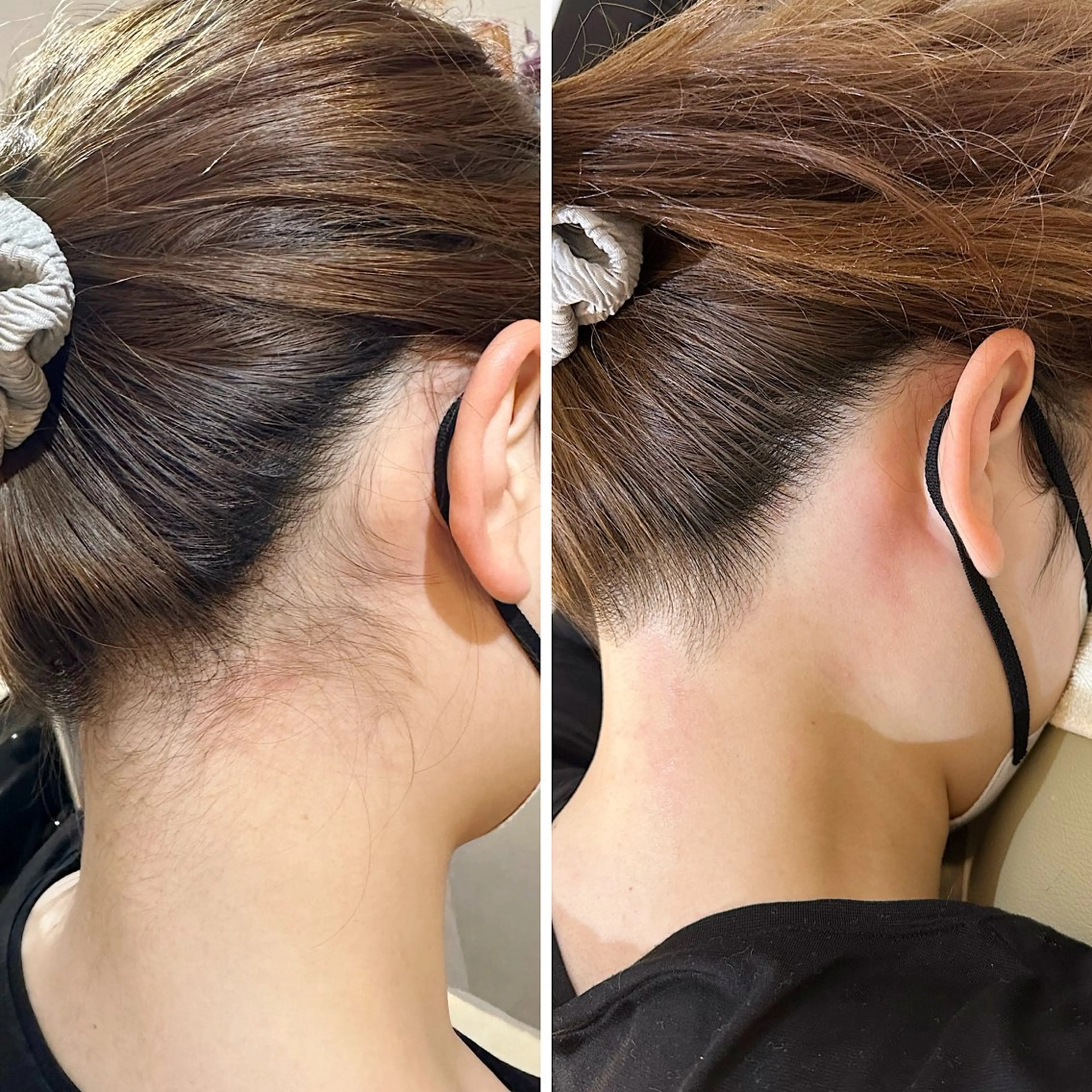 脱毛 うなじ脱毛/美肌脱毛 LABELのエステ・リラクイメージ