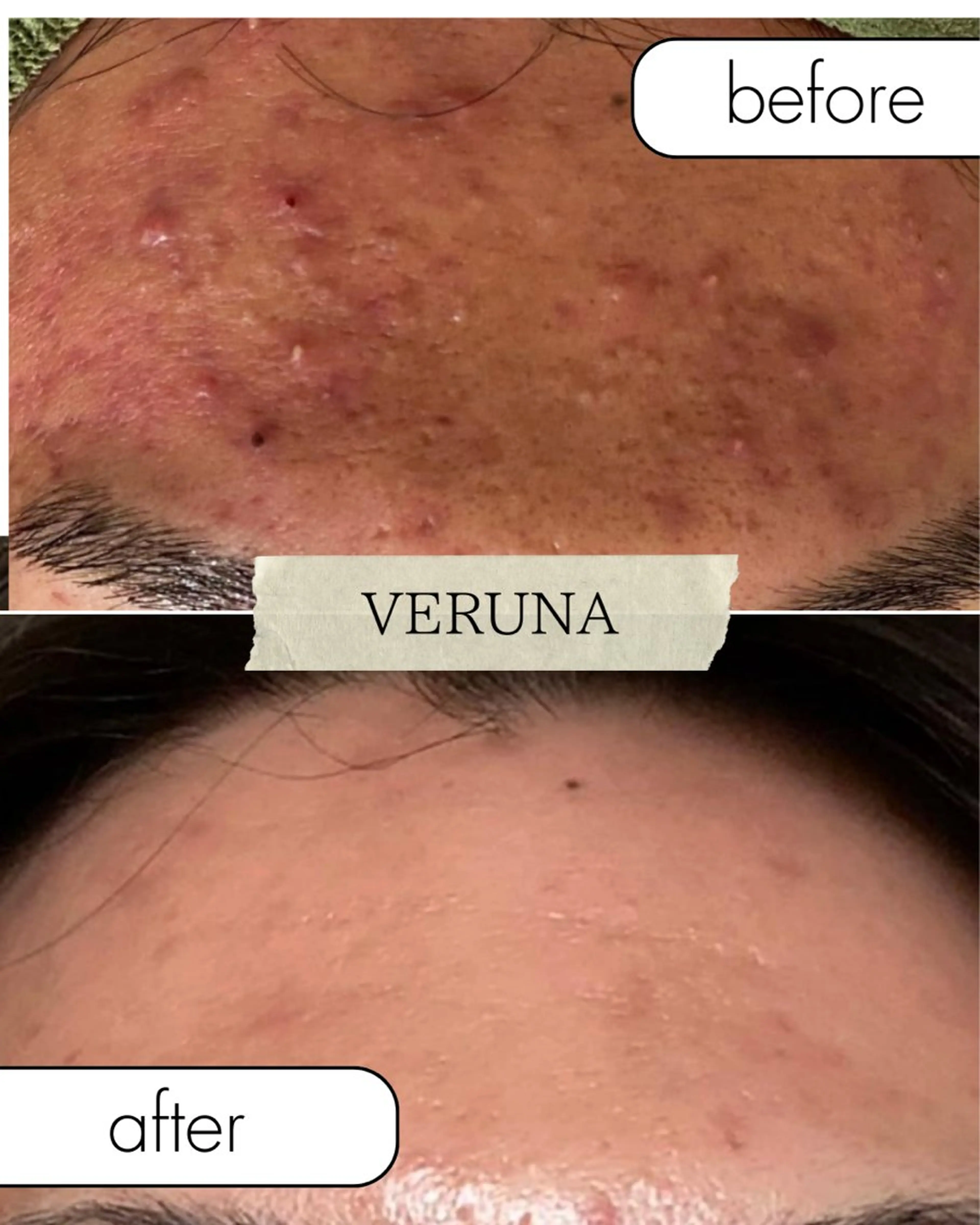 メンズOK!ニキビ、クレーター、毛穴にお悩みの方に効果絶対！ハーブピーリング（剥離あり）の写真