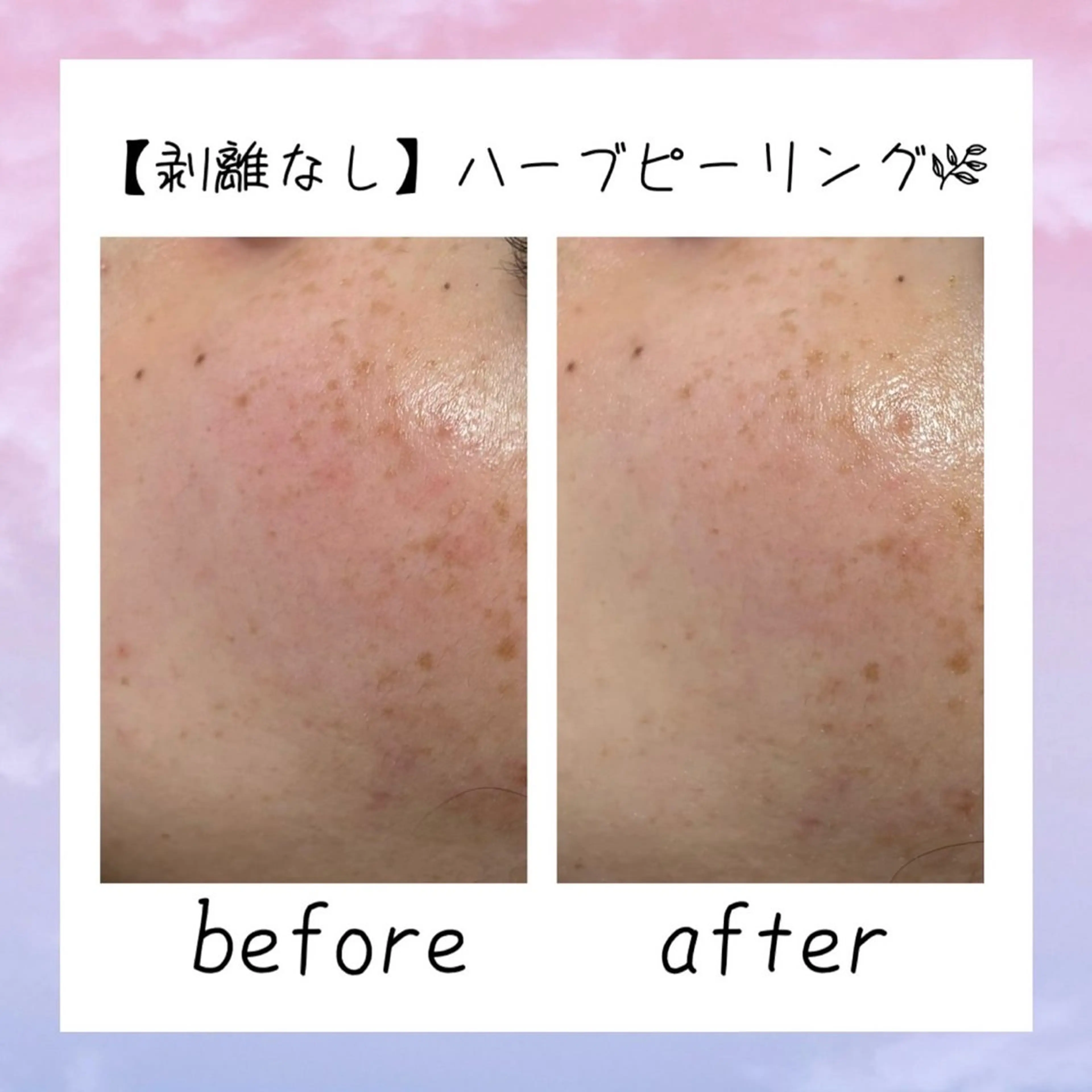 ニキビ改善シャルム ココハーブピーリングのエステ・リラクイメージ