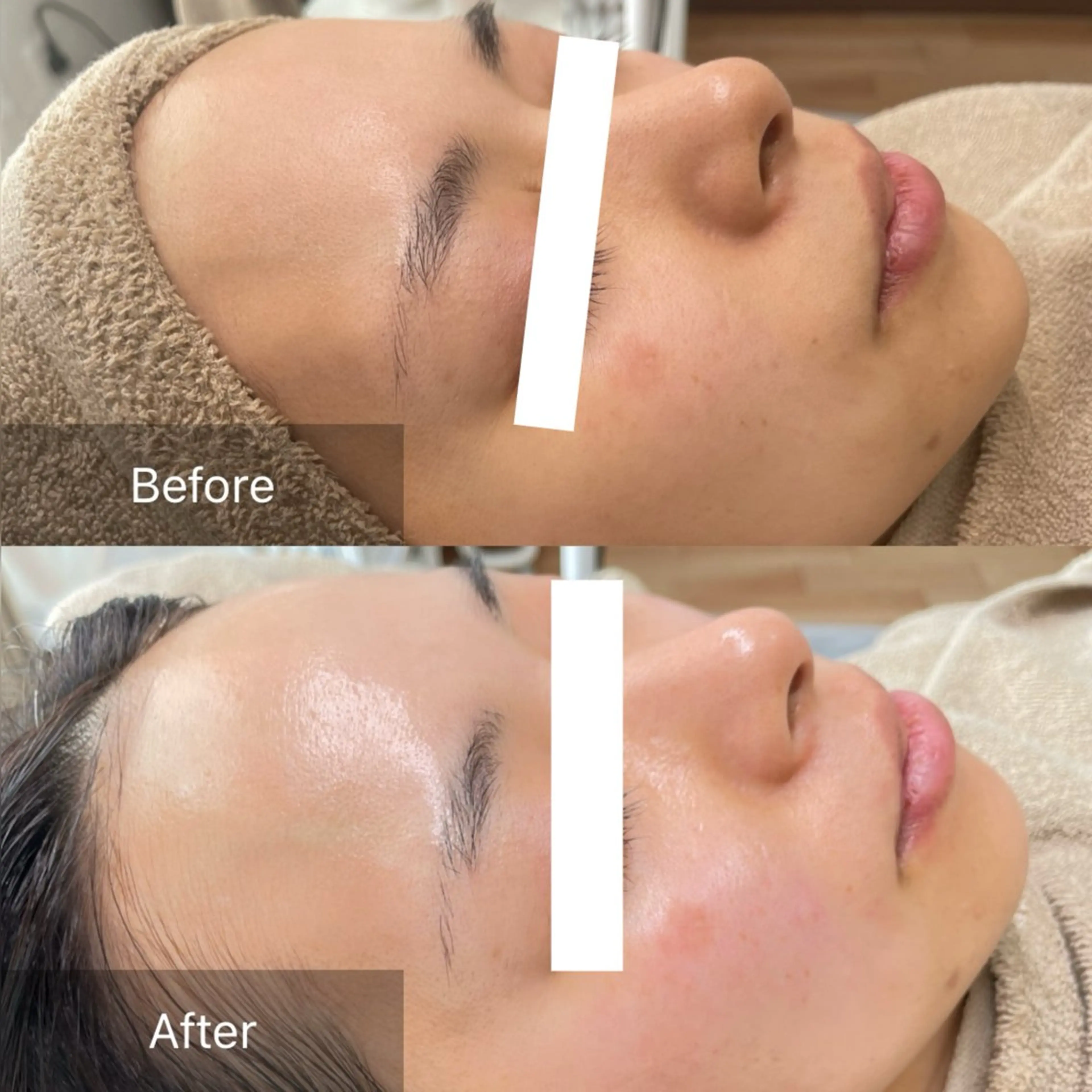 【ワックス顔脱毛が不安な方へ】おでこor鼻orアゴ⭐︎お試しメニュー⭐︎フェイスワックストリートメントの写真