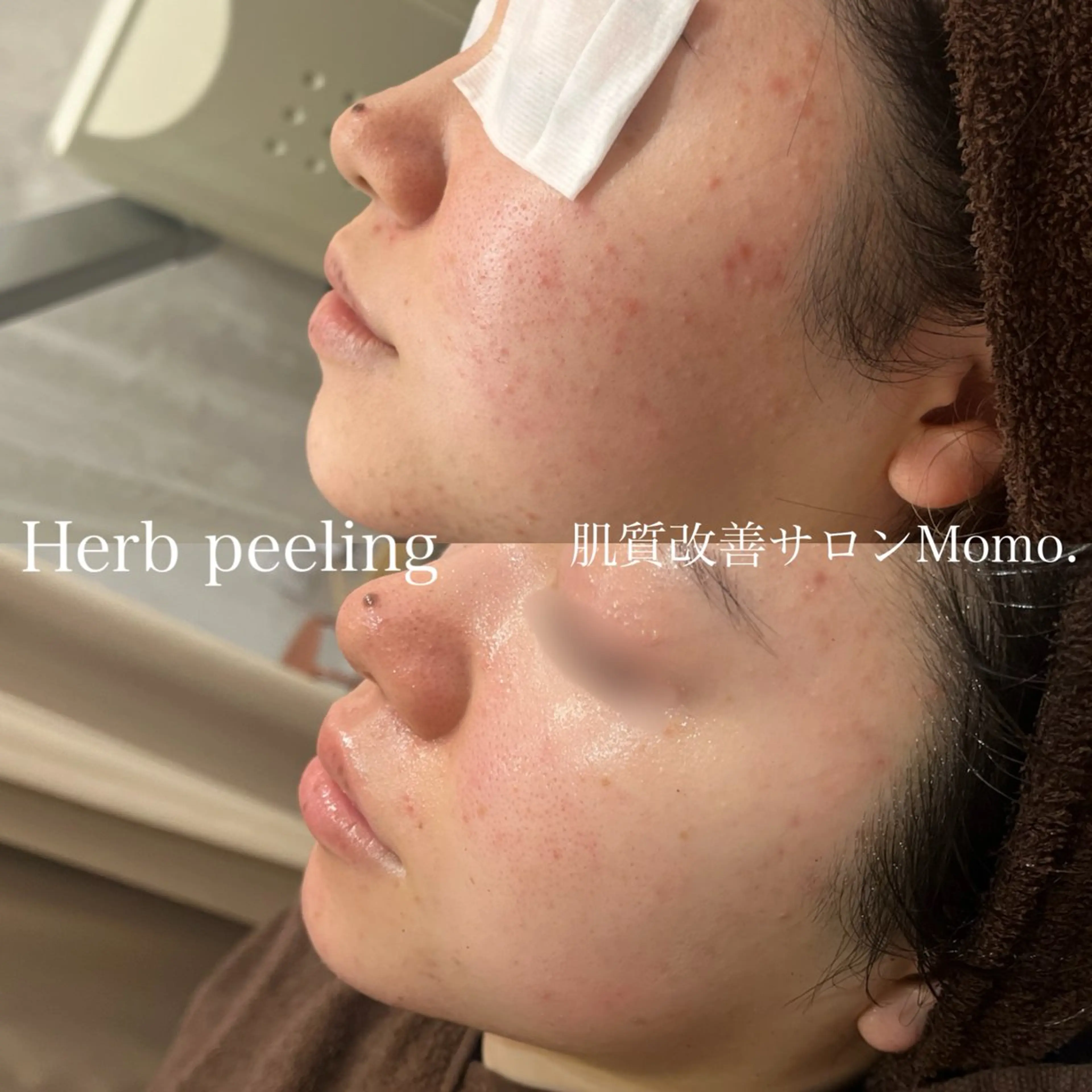 【人気No.1】剥けないハーブピーリング🌿スチーマー洗顔&高保湿パック付の写真