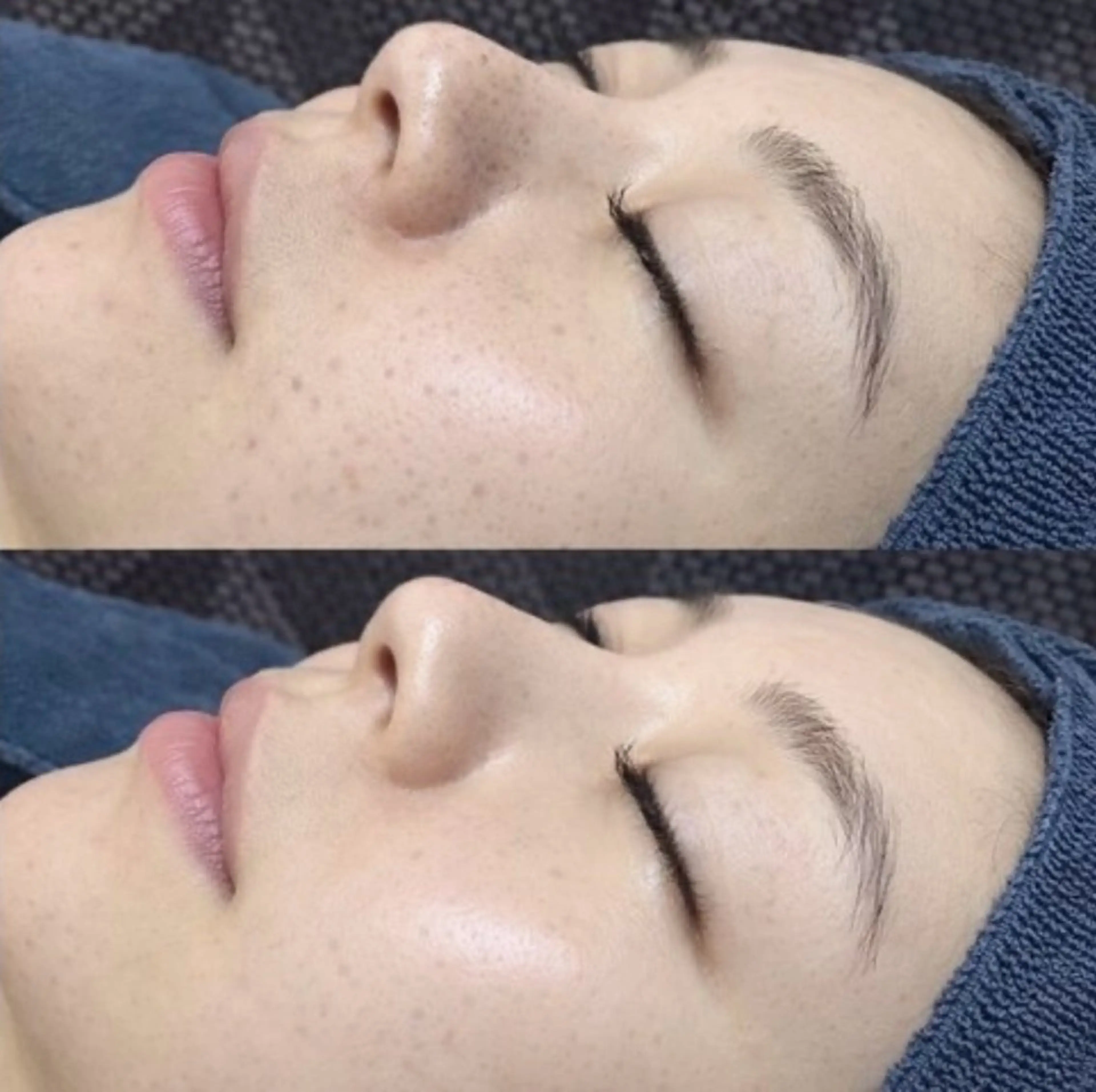 【最新ピーリング】めくれない、一度で驚きの効果も即実感♪シワシミたるみや肌荒れニキビ肌にも◎の写真