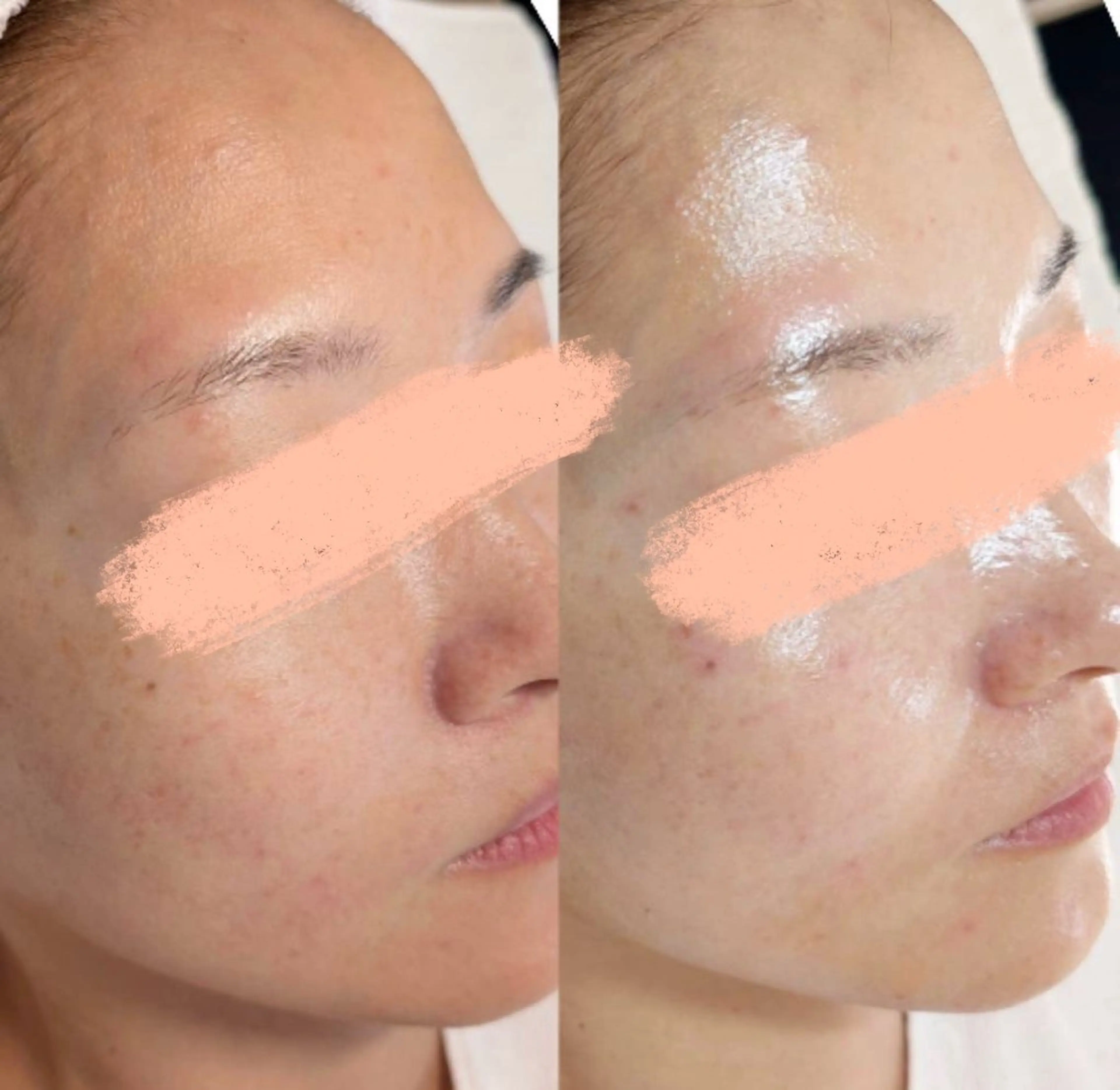 【圧倒的人気No.１✨】ララピールの進化版、乳酸菌配合セラピール＋美白IPLフォト＋セラパックの写真