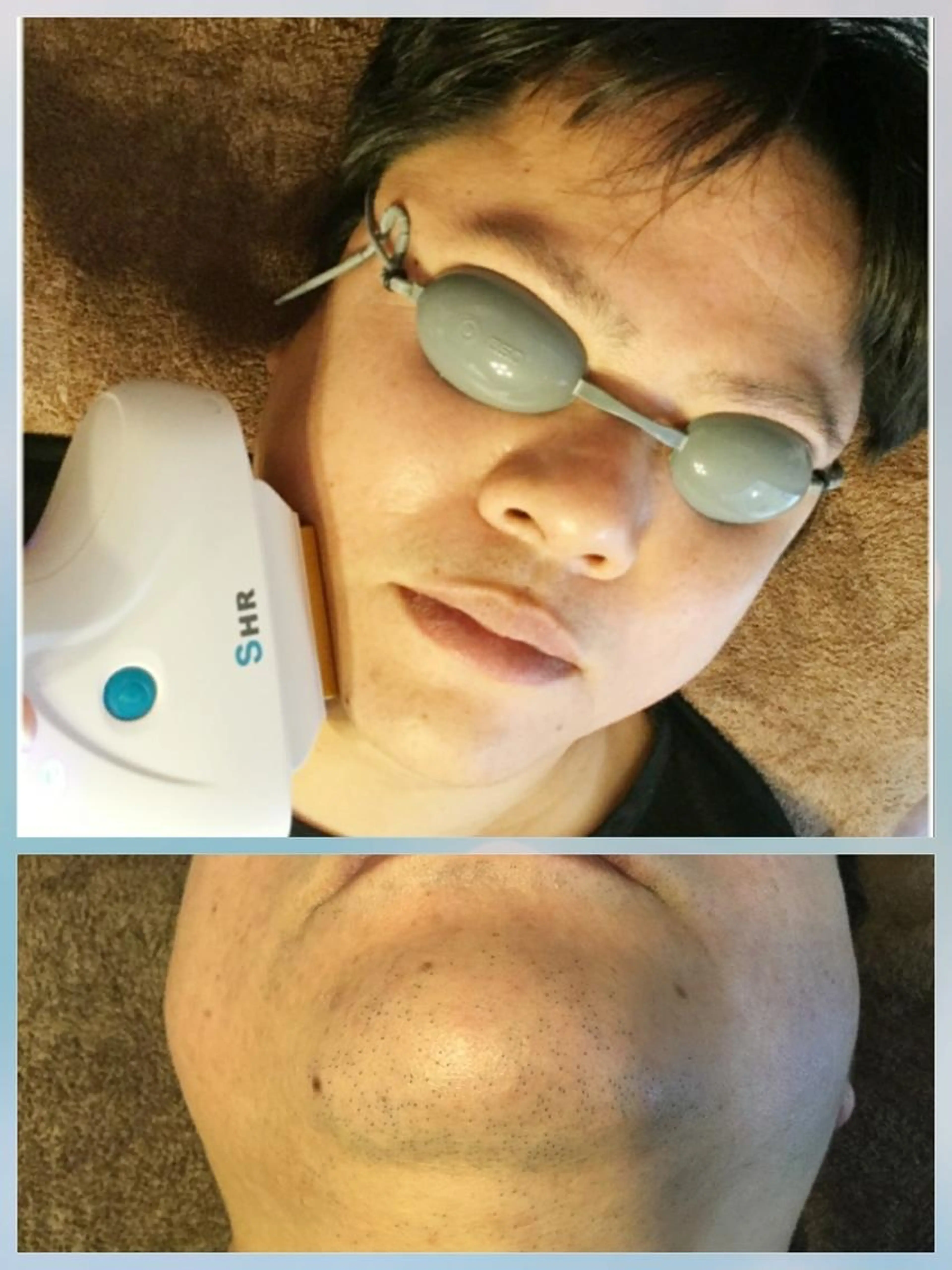 男性☆ヒゲ脱毛☆ ヒゲ全体 お試し2回セット！！の写真