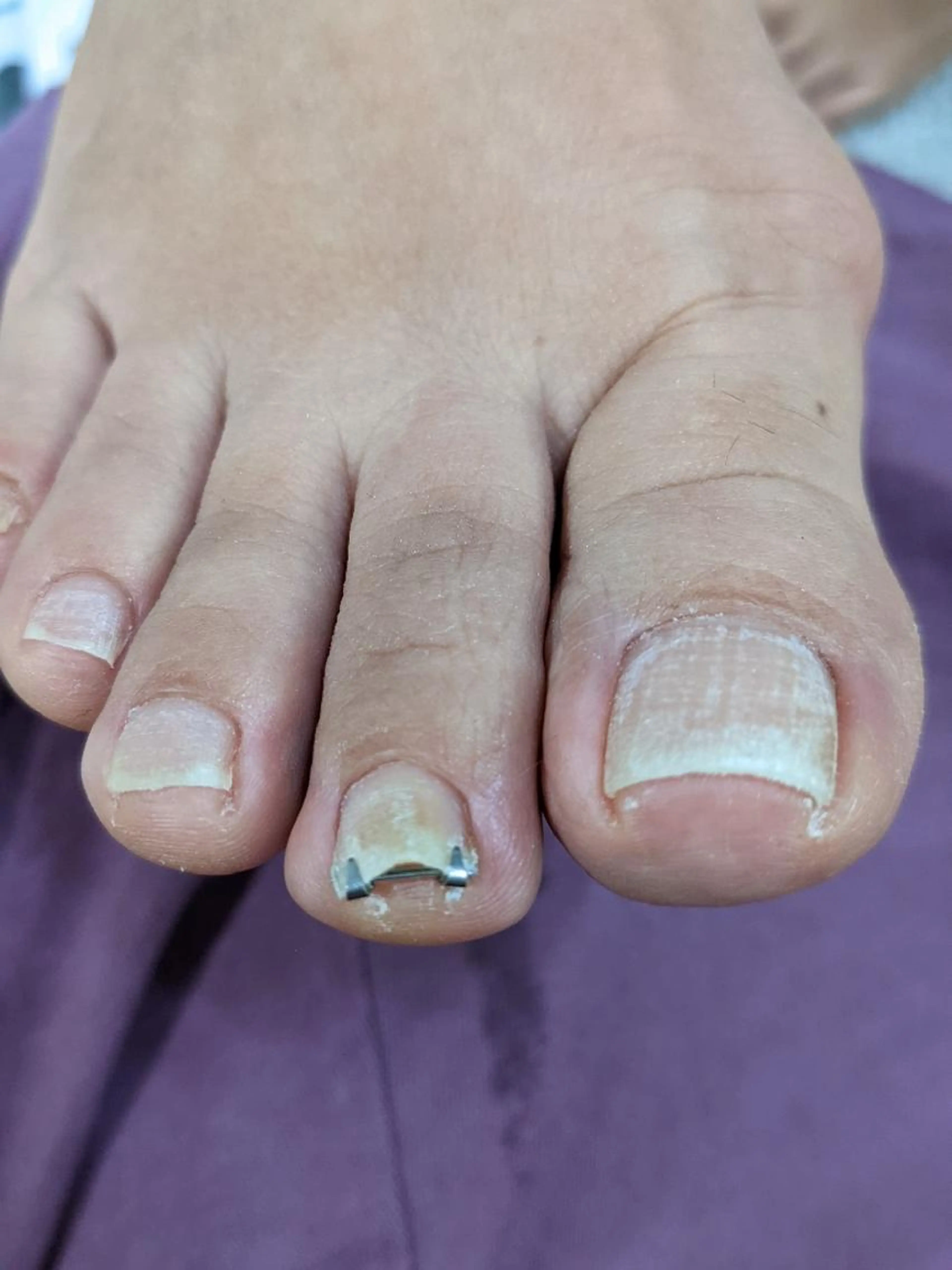 巻き爪リフトによる巻き爪矯正の写真