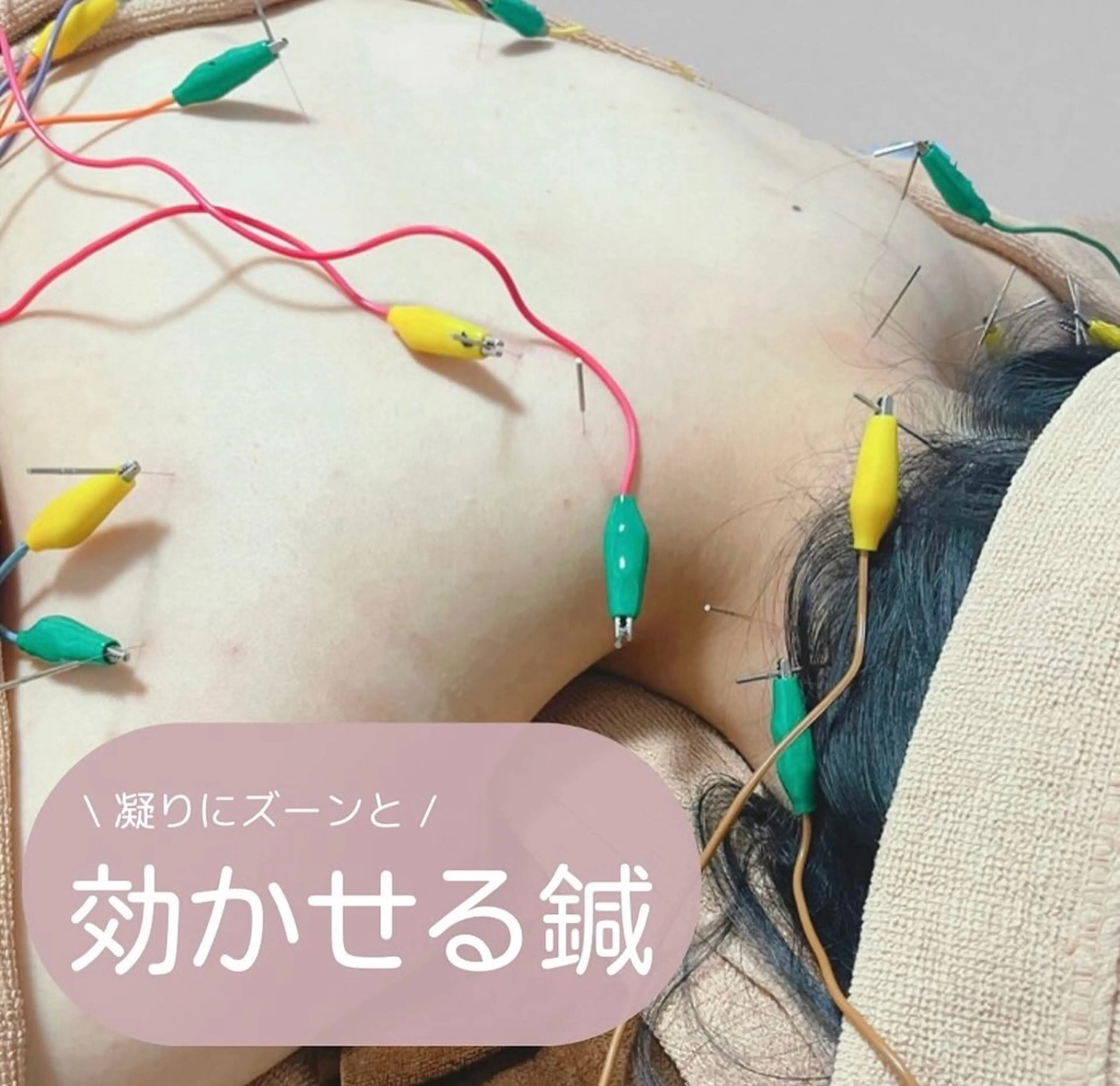 美容鍼/鍼灸 ここみ鍼灸院のエステ・リラクイメージ