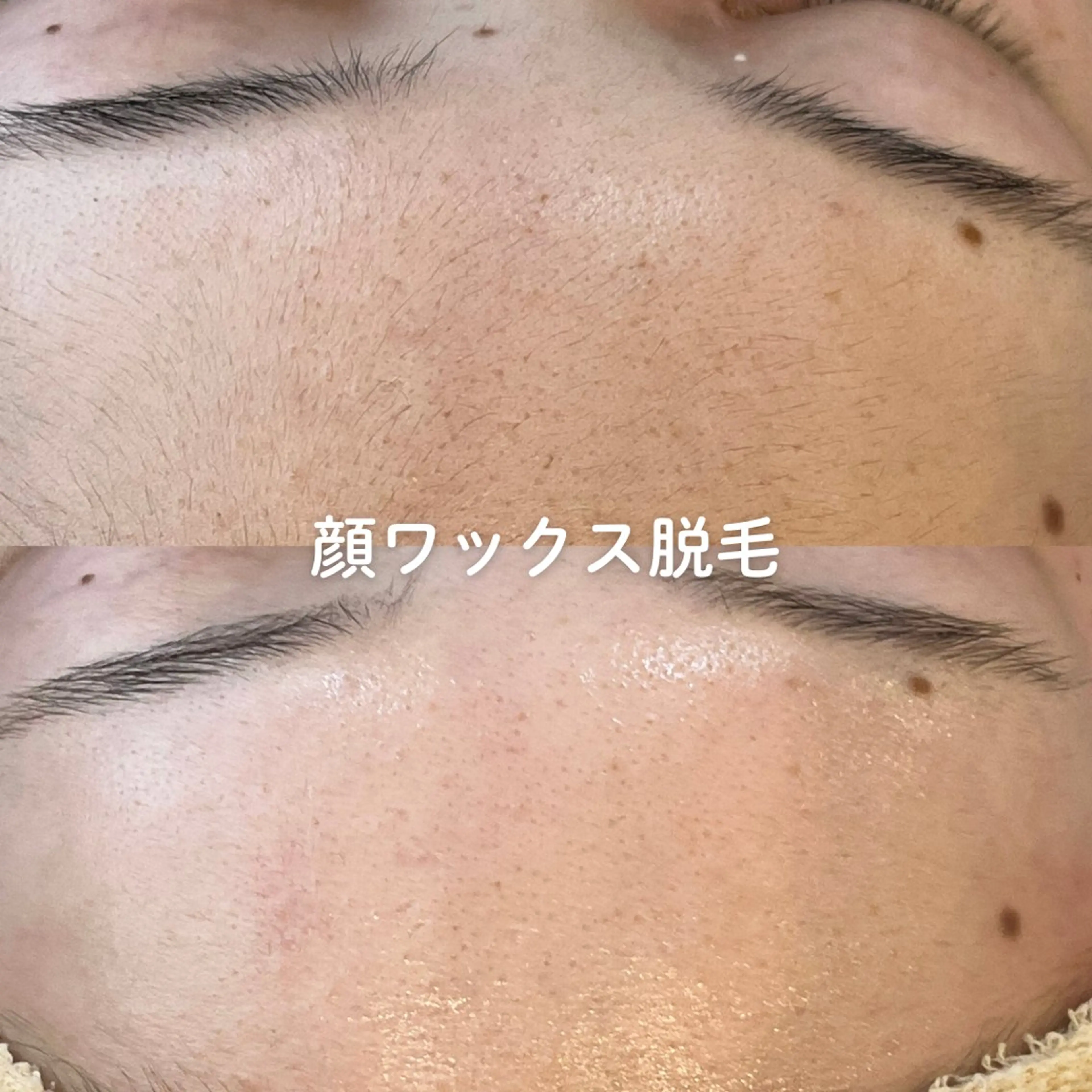 春限定価格🌸顔の産毛が気になる方に◎顔ワックス脱毛【口コミご協力いただける方】の写真