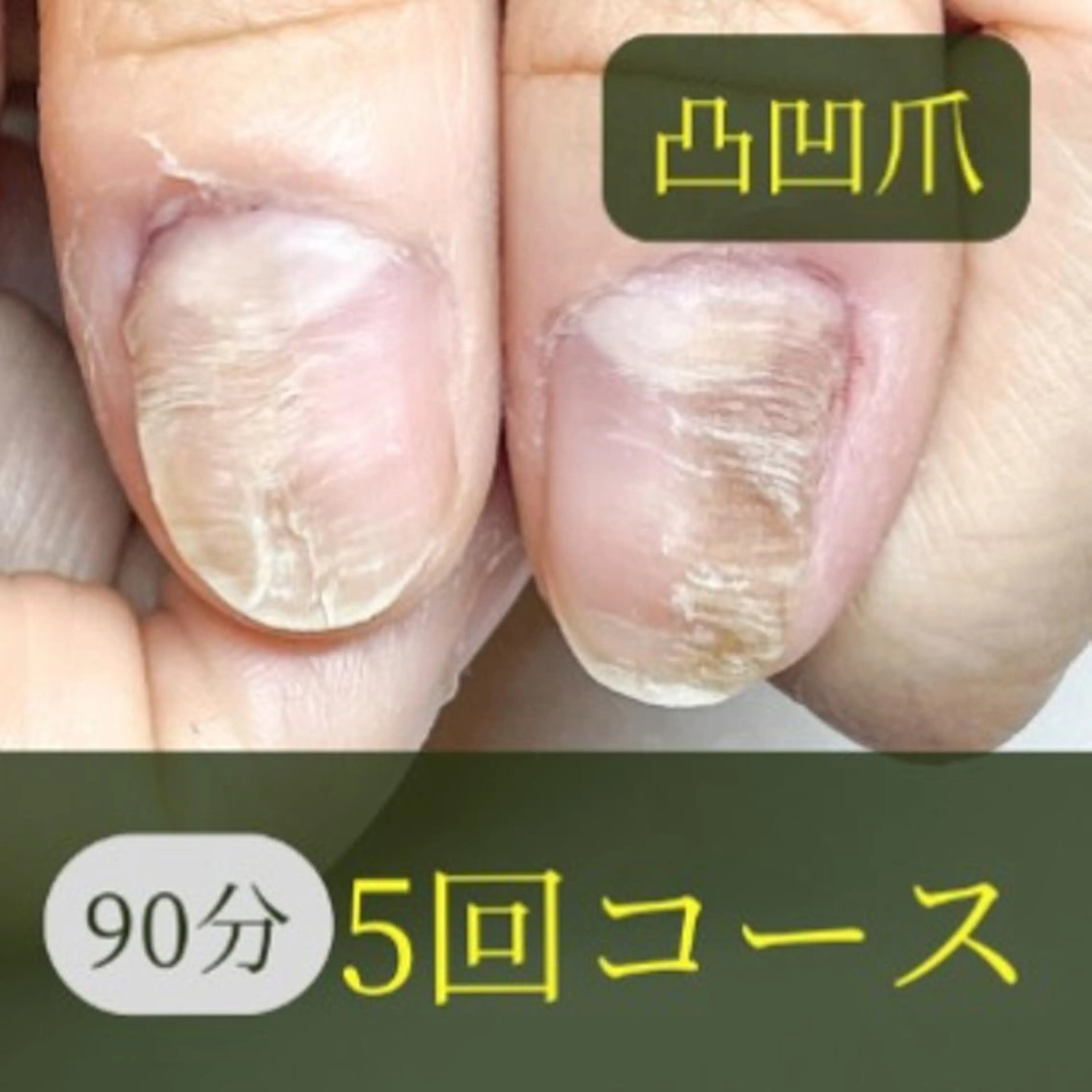 5回コース/爪変形-凸凹(90分)の写真
