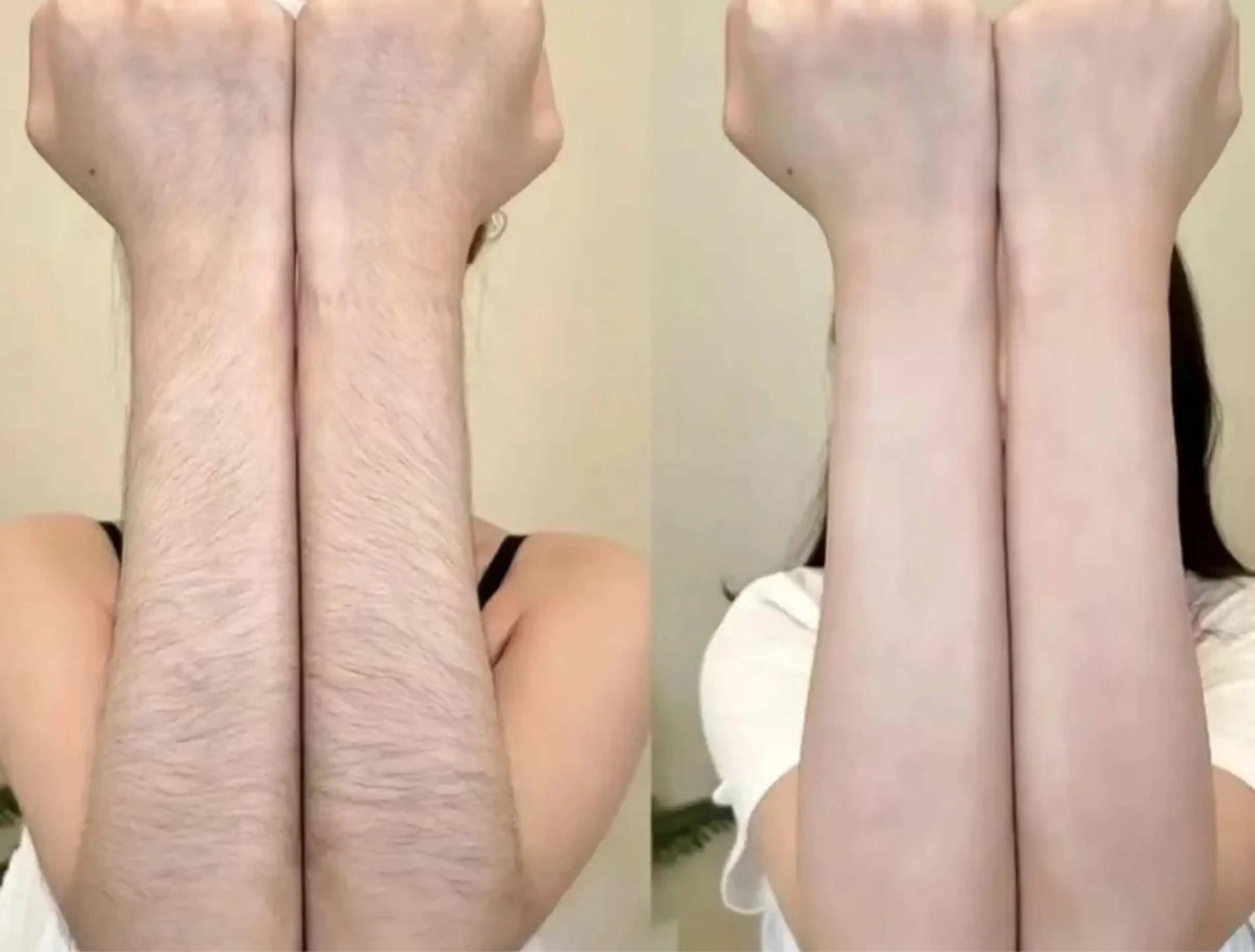 両腕脱毛の写真