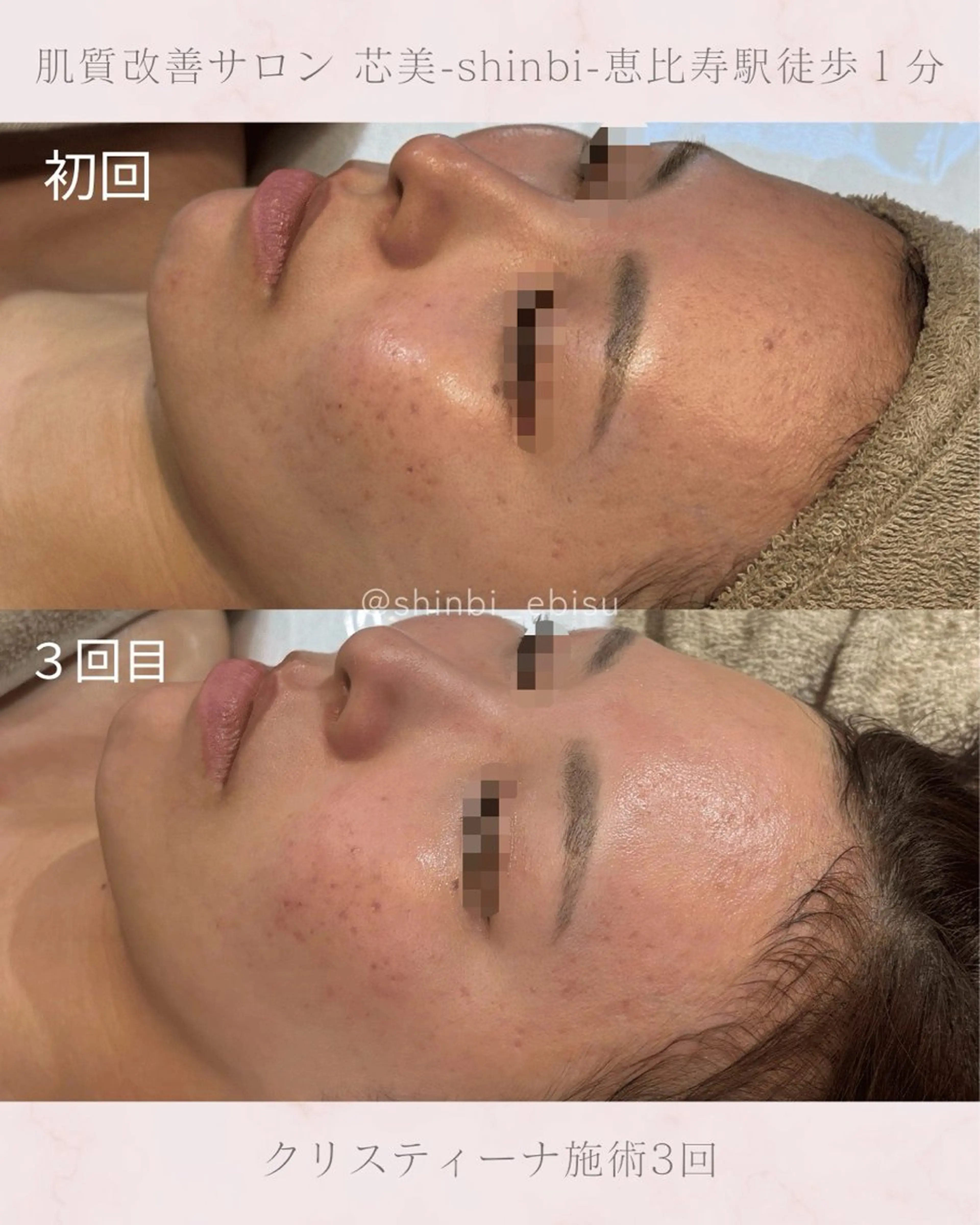 【新規】繰り返す肌荒れ/くすみ/血行不良が気になる方♡剥離なしハーブピーリング1回🌿.∘小鼻毛穴洗浄込み!の写真